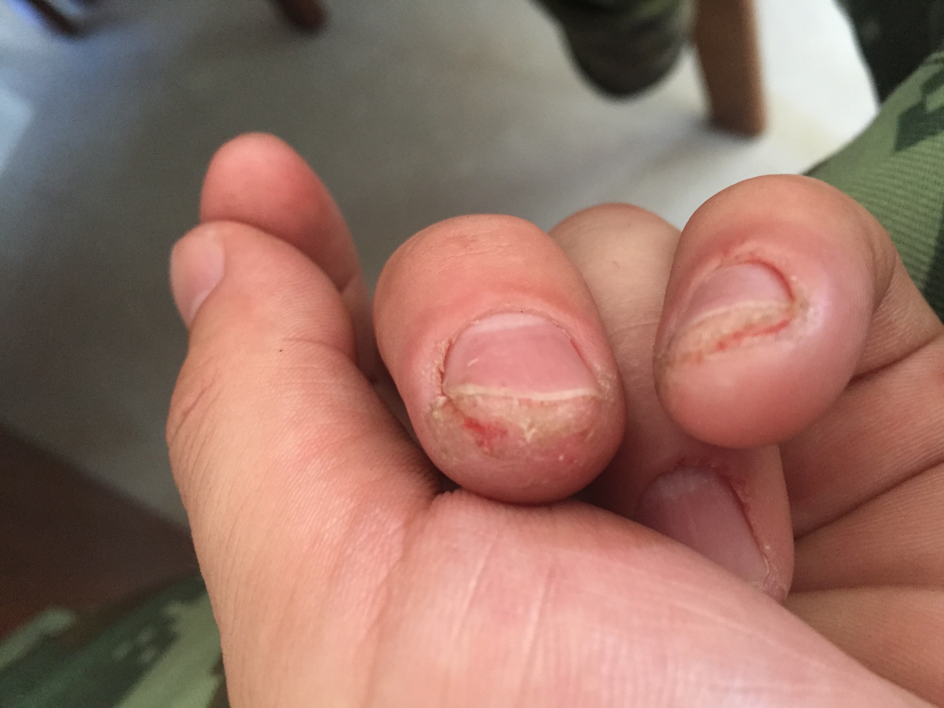 手指头开裂有水有两个多月了