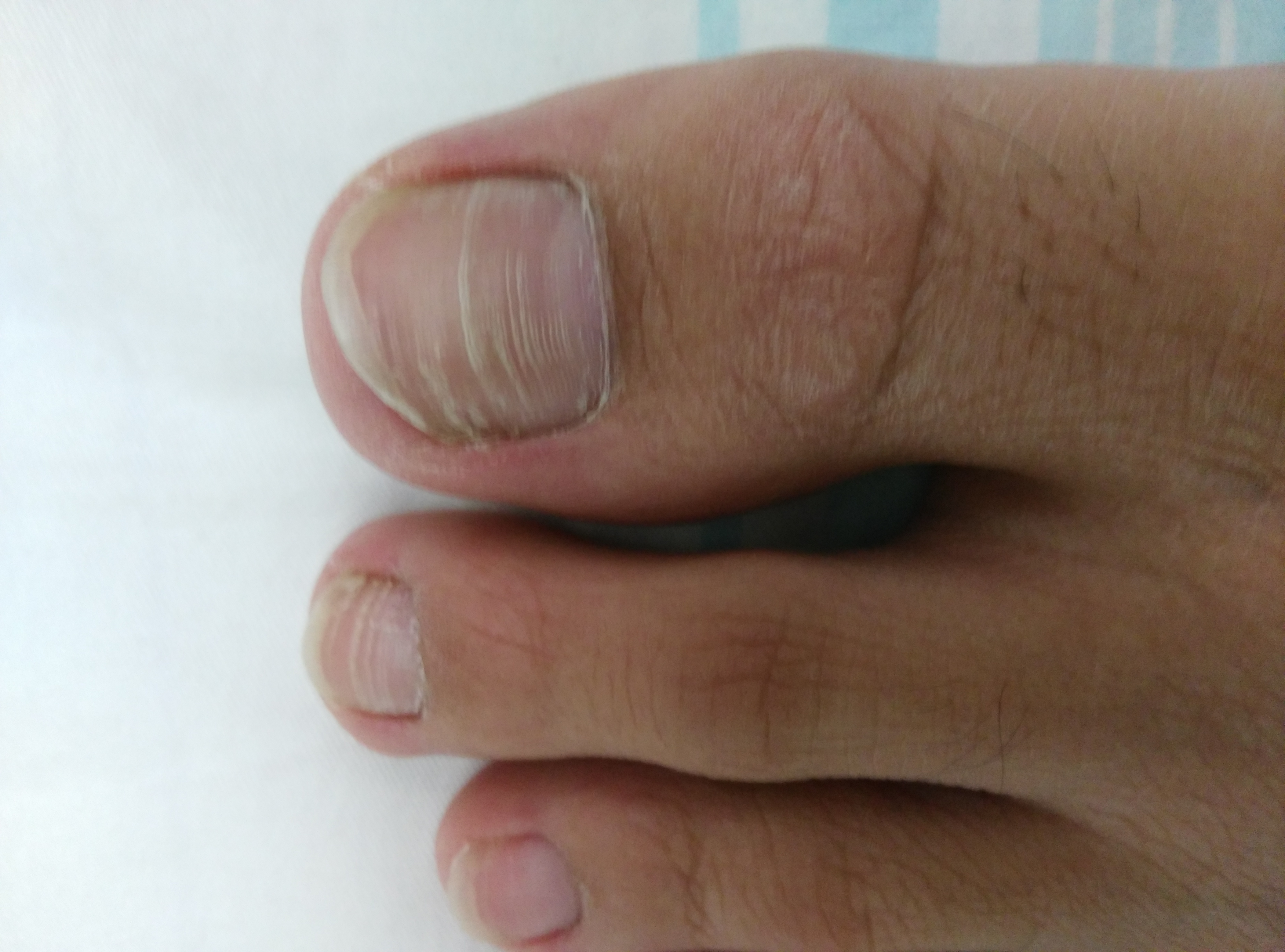 脚指甲竖纹肝癌图片图片