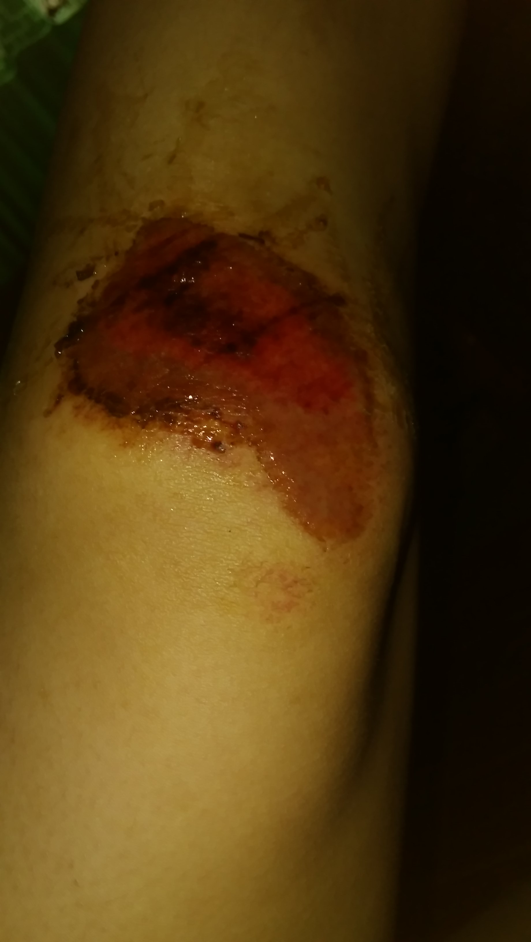膝盖摔伤了肿了的照片图片