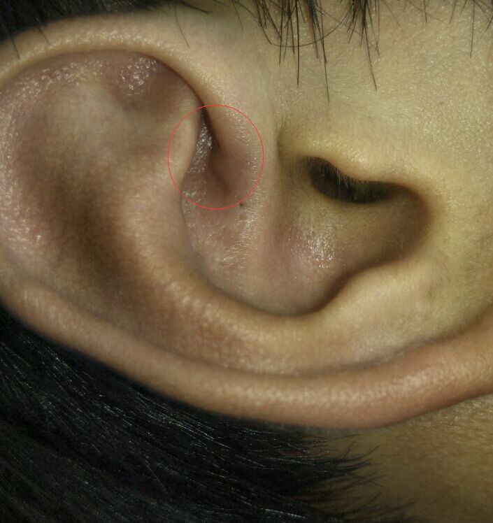 耳朵长肉疙瘩图片图片