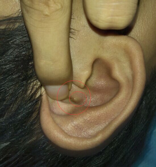外耳道长肉芽图片