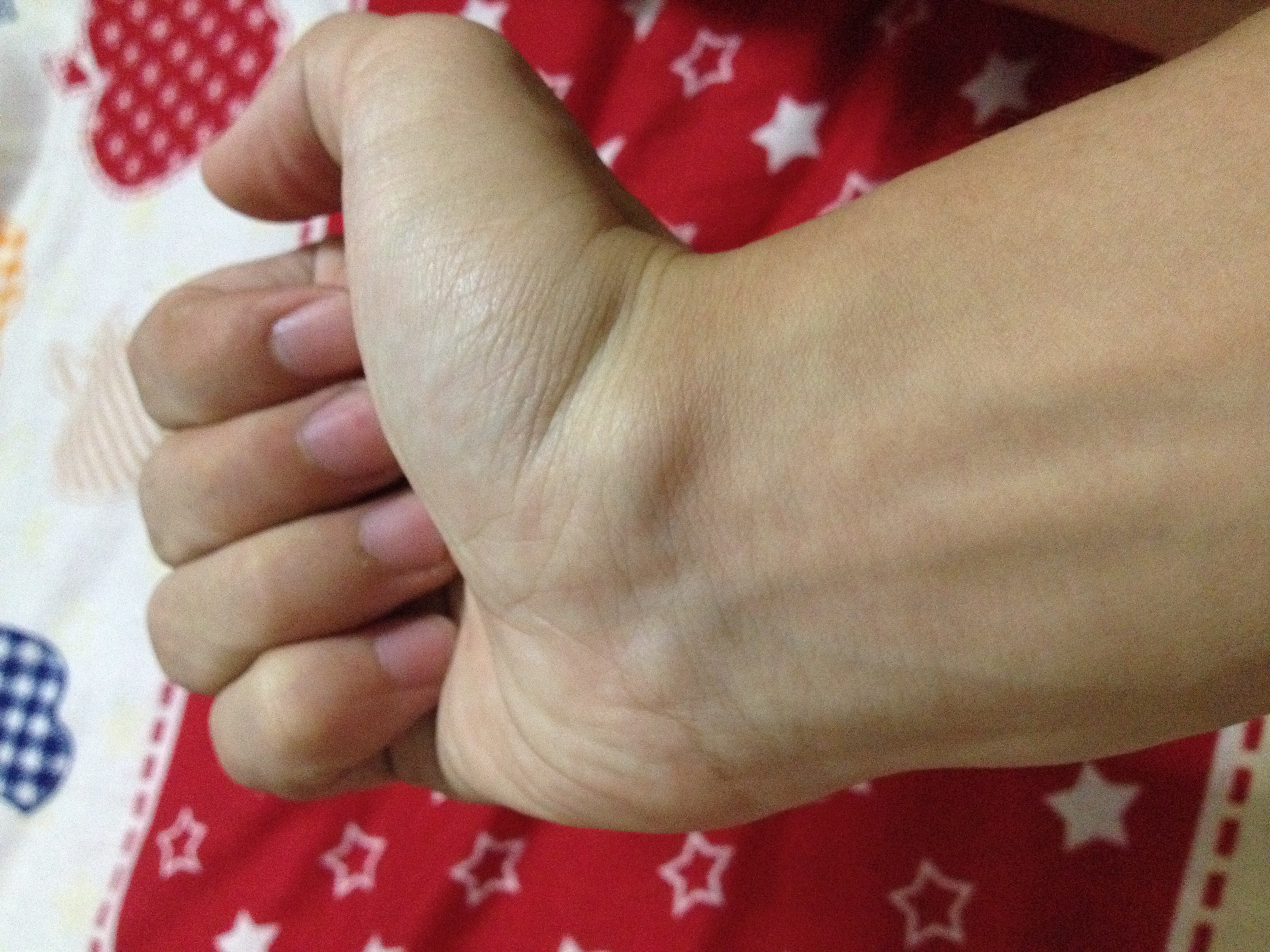 手腕筋疙瘩图片图片