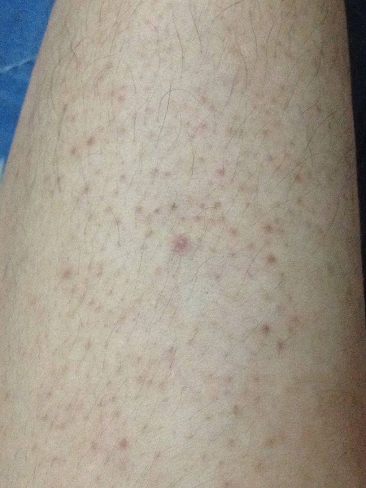 两条小腿上有许多小红点大腿内侧也有一些不痛不痒有好多年