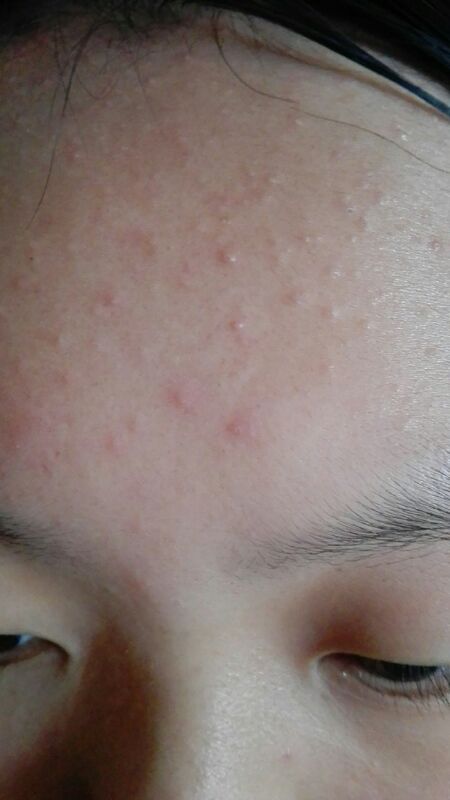 脸上起了好多小包不像是青春痘过了好久也没有减少的迹象