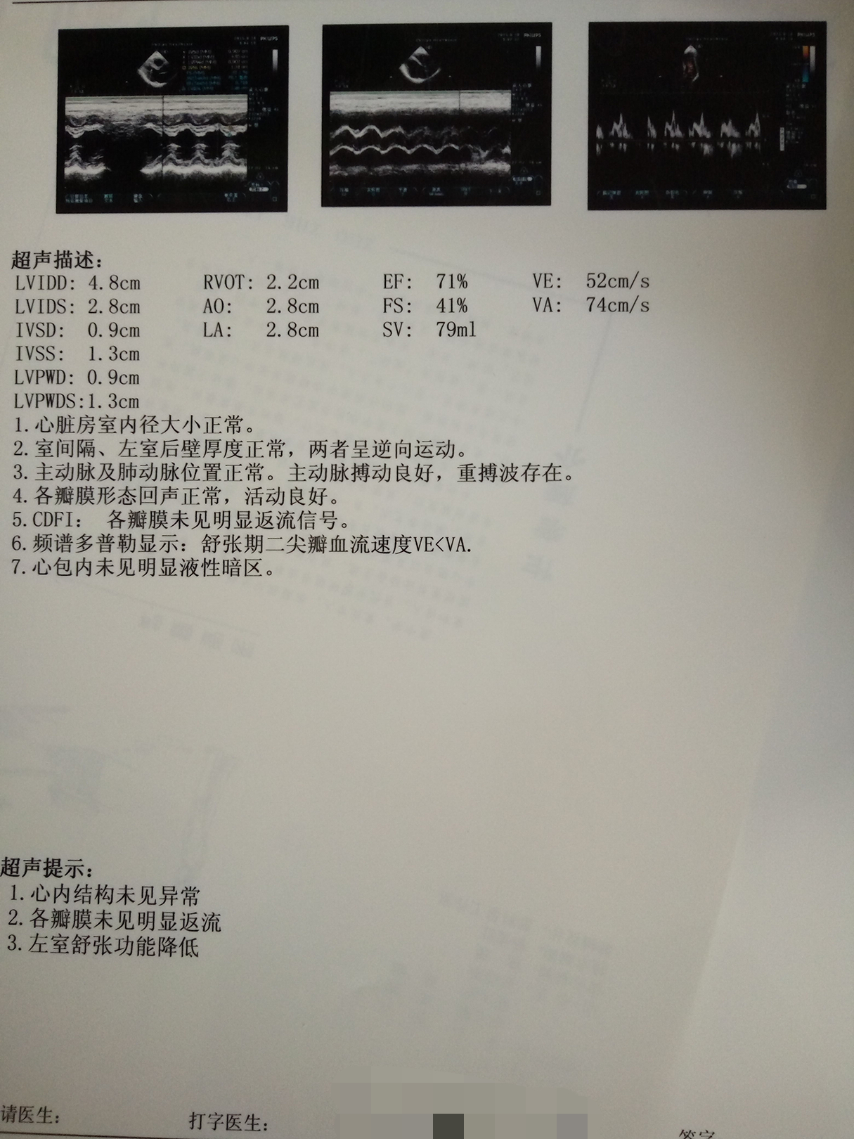 医生请问一下,心电图v1呈qs型,心彩超左室舒张功能降低,平