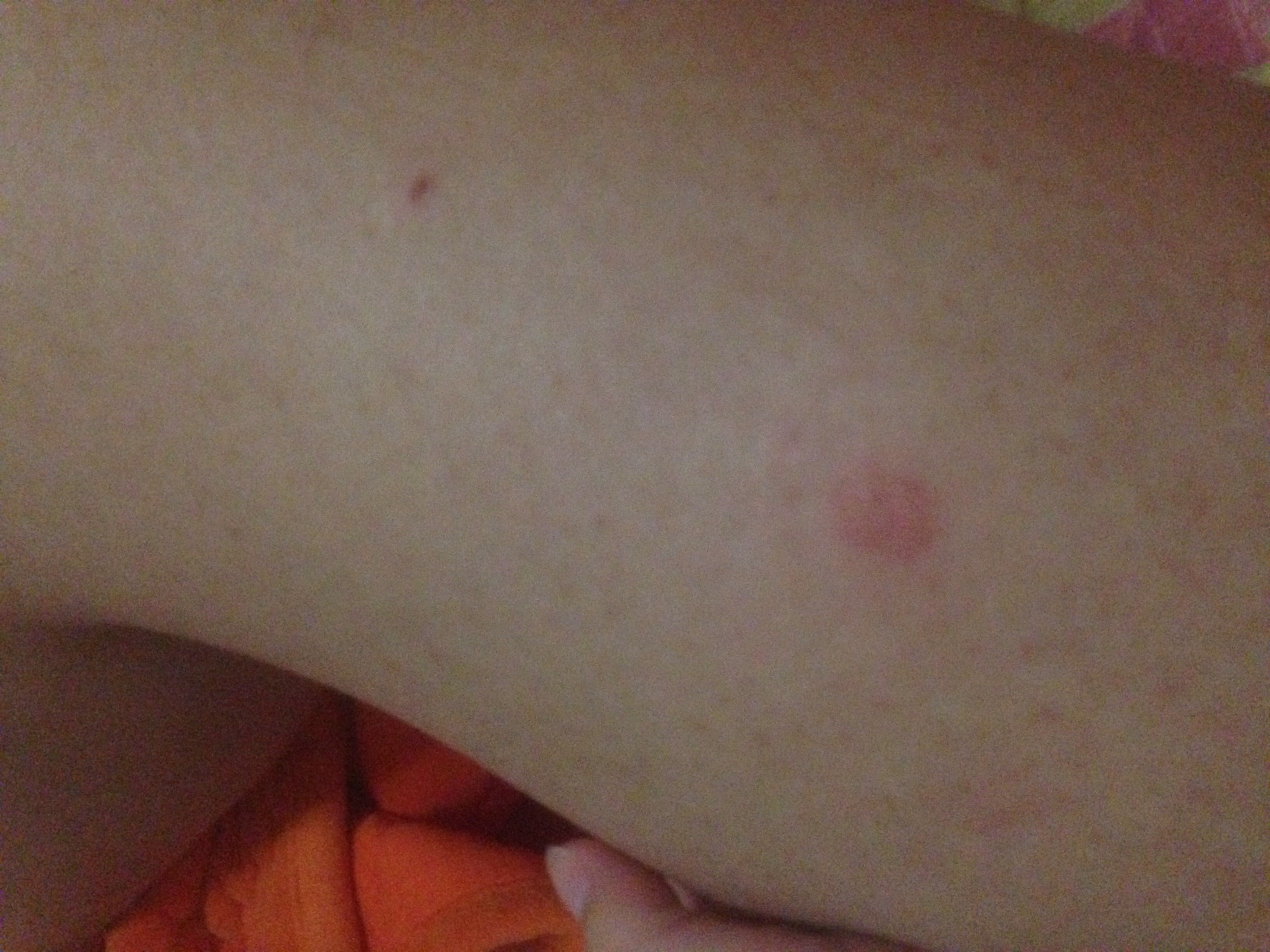 我脚上长了一个鸡皮疙瘩很痒(我脚上长了一个鸡皮疙瘩很痒怎么回事) 我脚上长了一个鸡皮疙瘩很痒(我脚上长了一个鸡皮疙瘩很痒怎么回事)