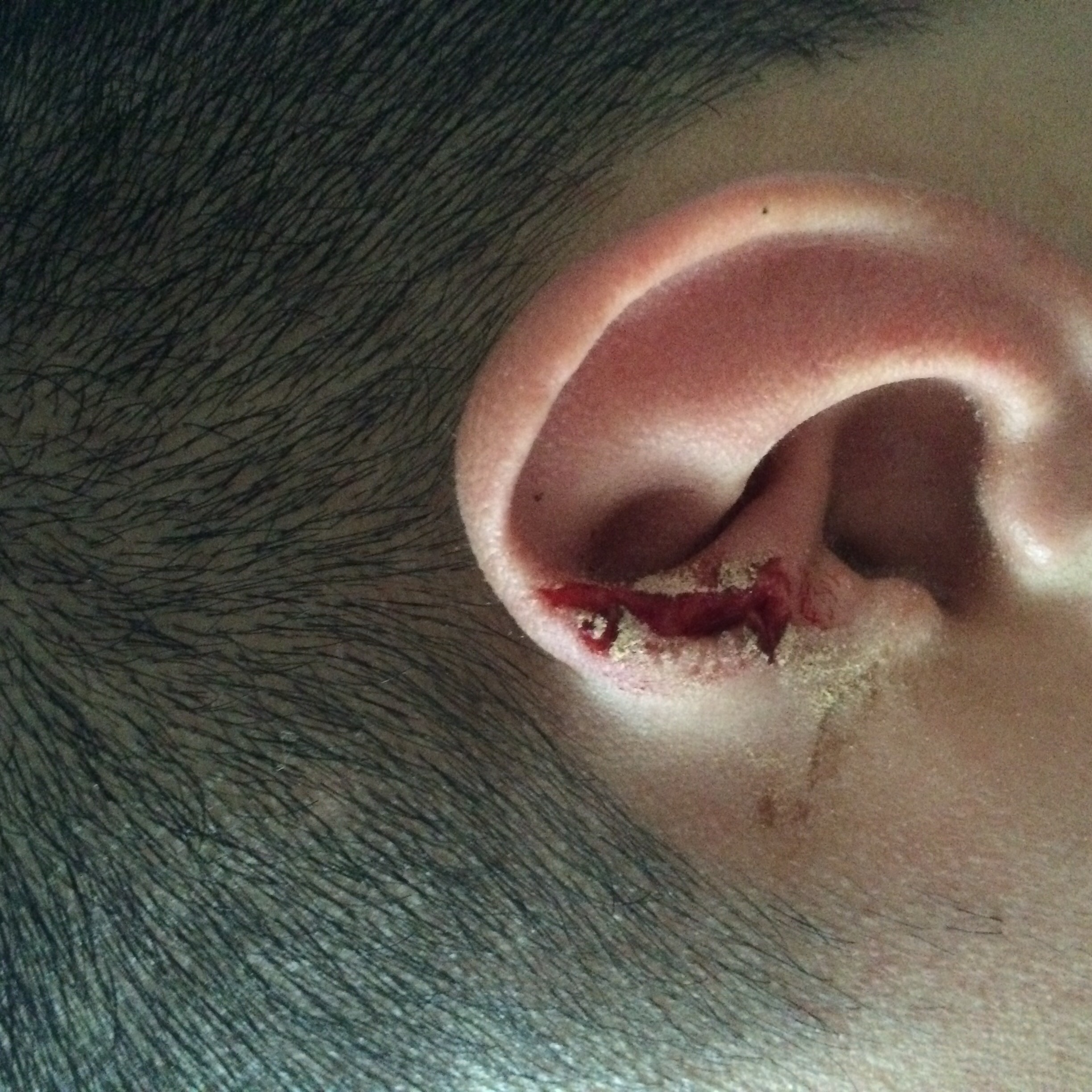 耳朵被钉子划伤,问题严重吗?需要怎么处理呢