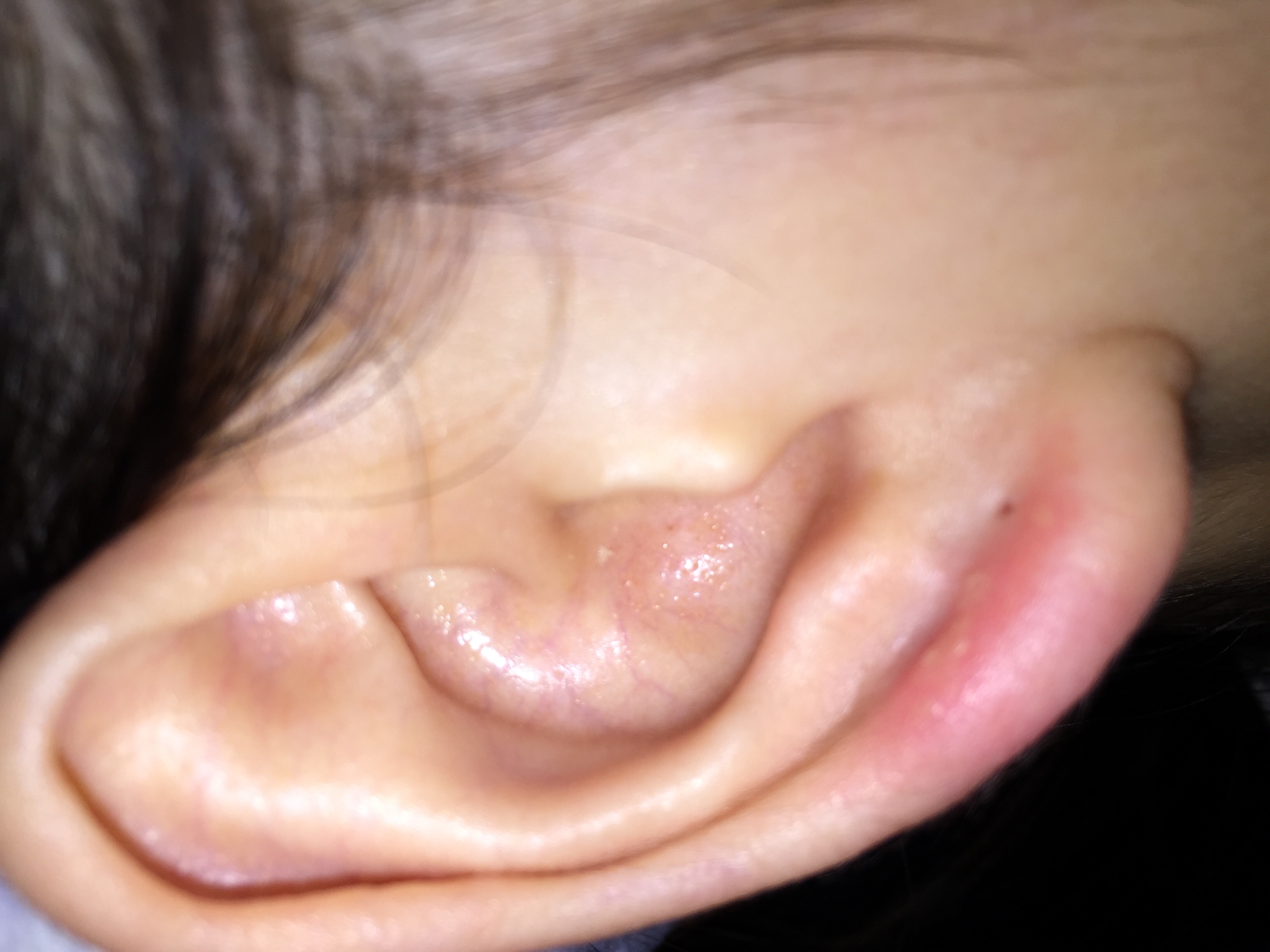 耳朵疖肿最快消除办法图片