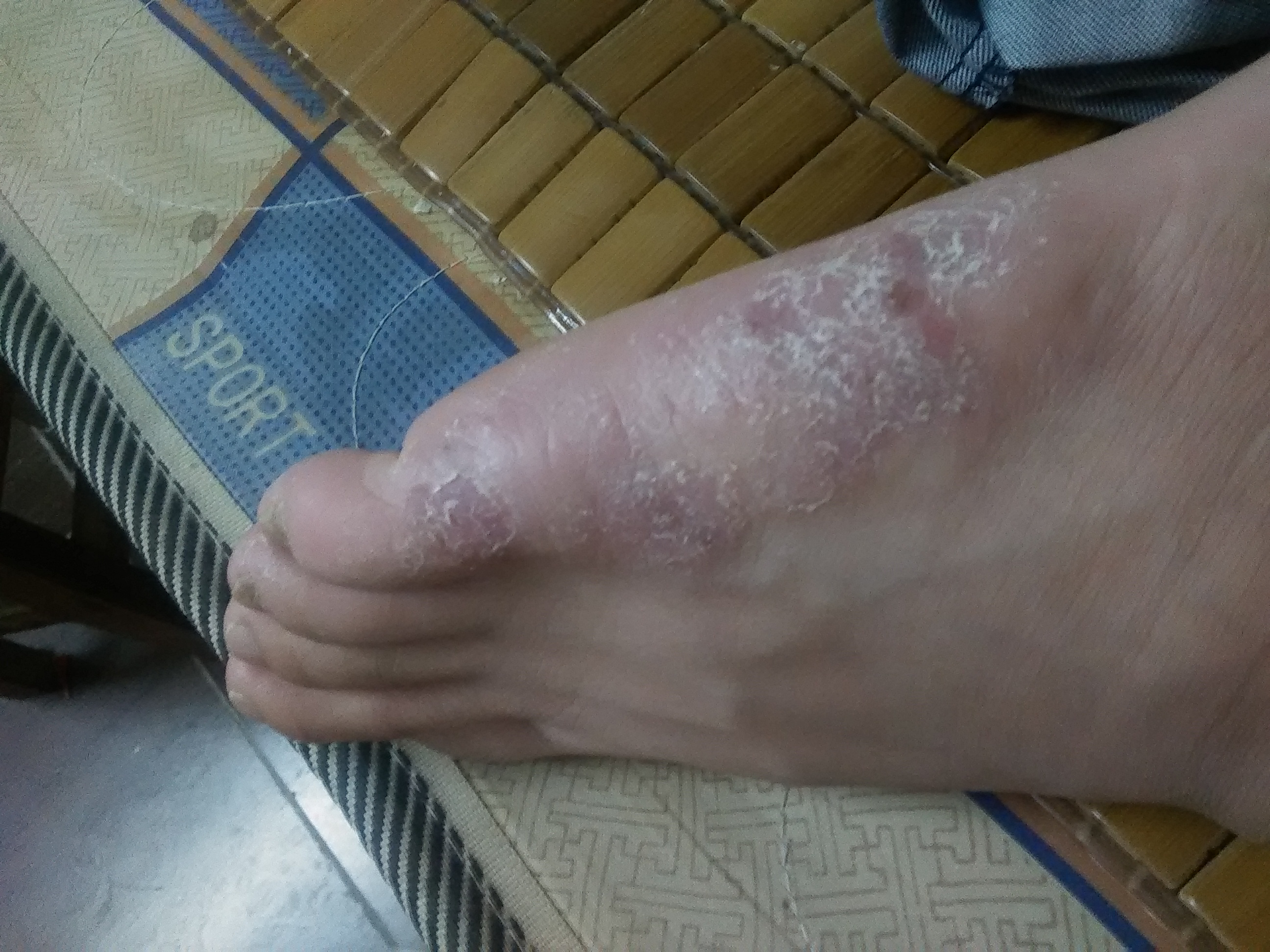 双脚有小水泡发痒把水泡弄破就有个深深的洞_皮肤科_邻医网