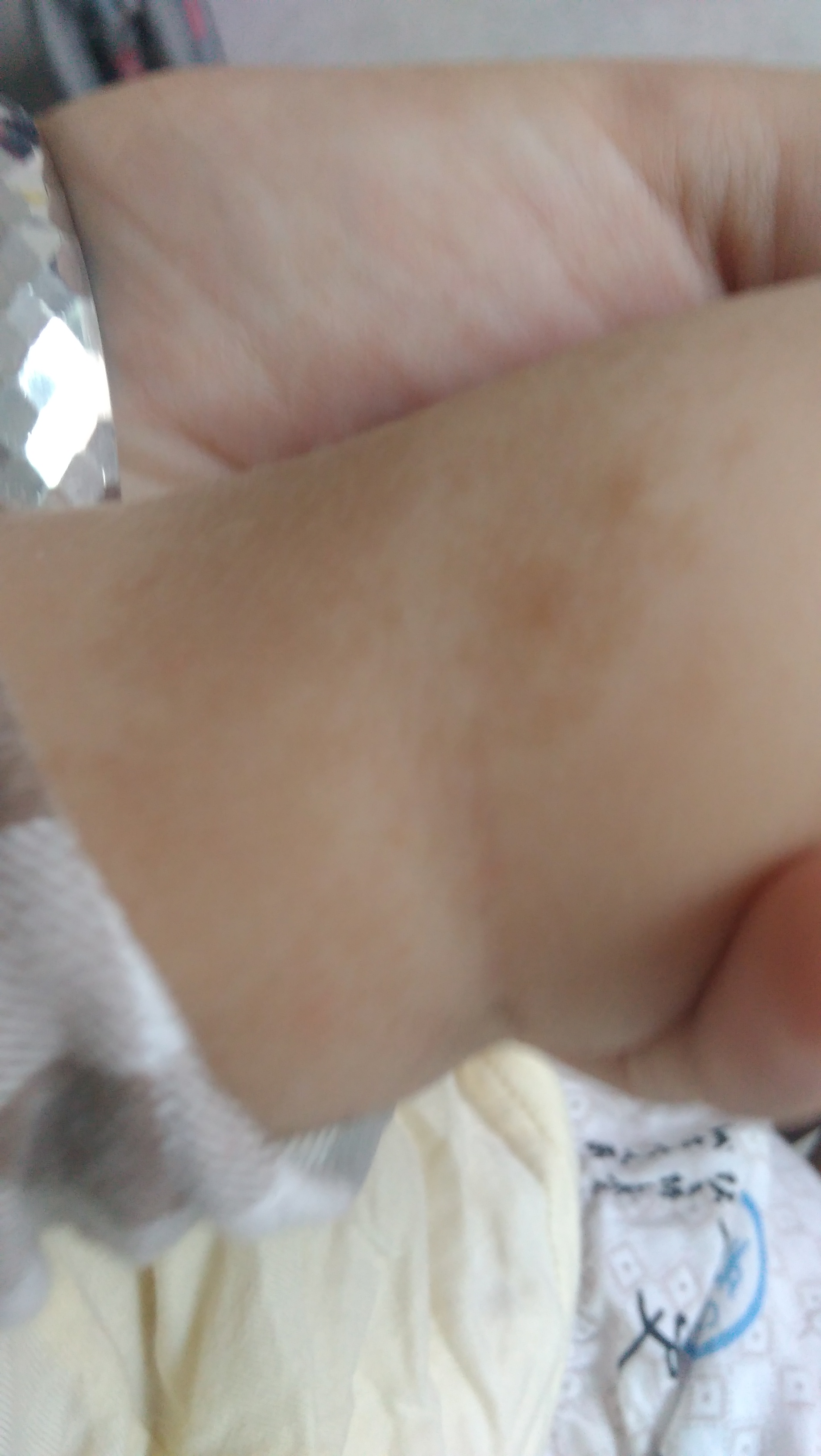 宝宝六个月大手上有斑,出生的时候没发现