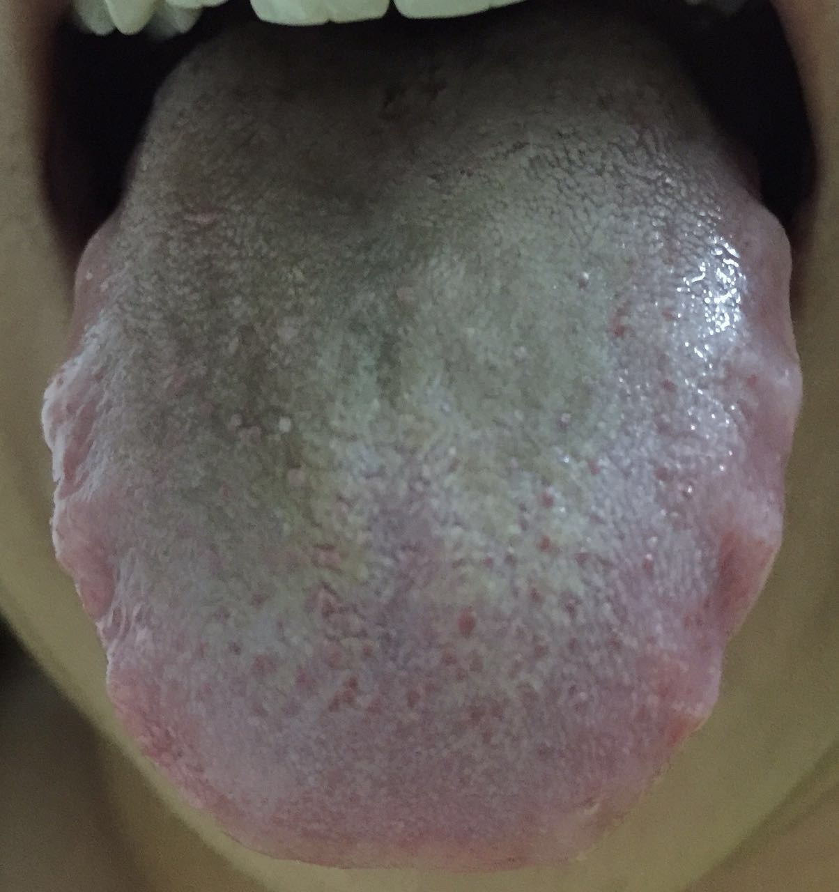 舌苔发白是不是胃出问题了