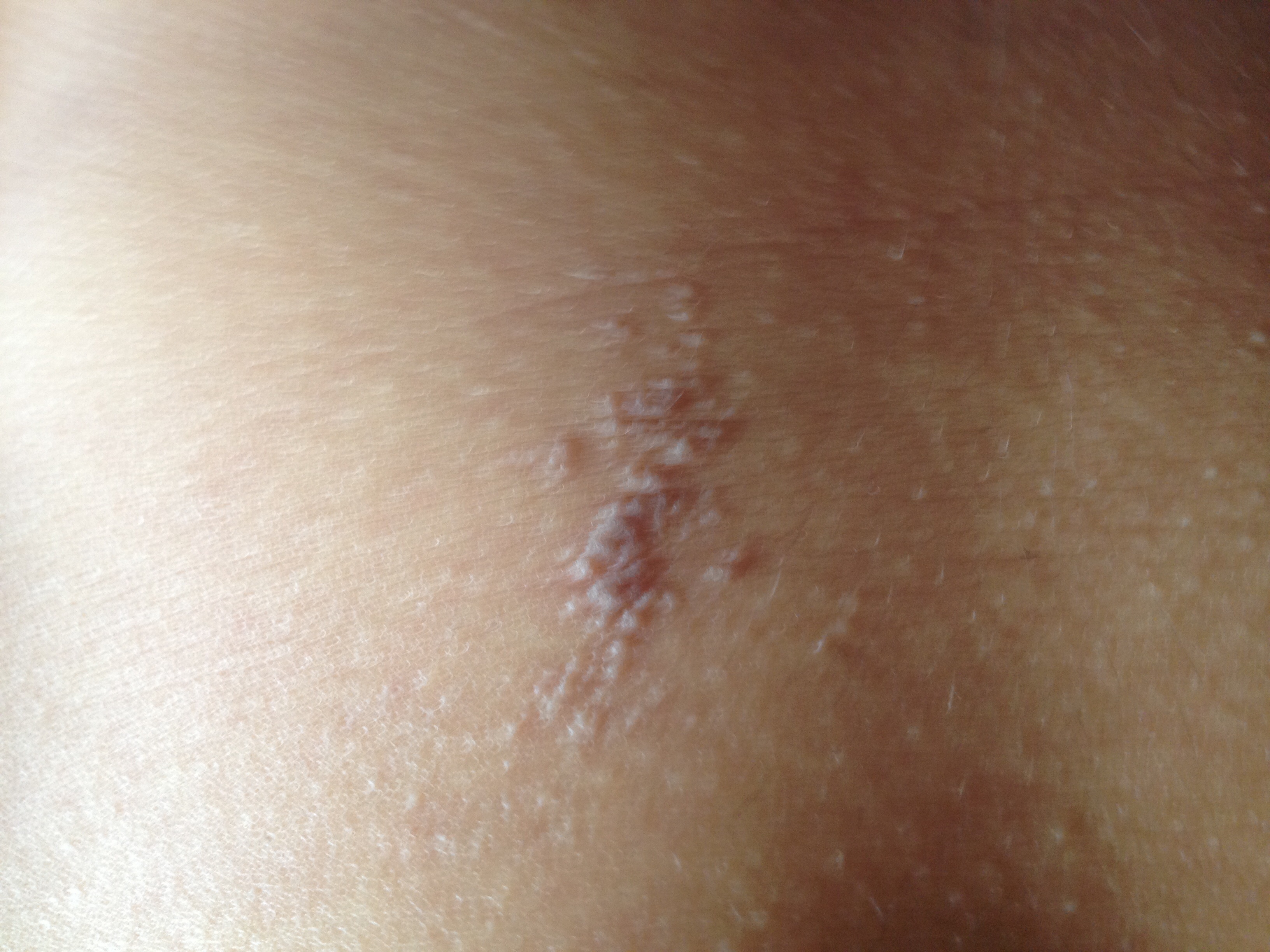 肚子上长了红疹,开的是淡红色,没留意去碰它慢慢变成黑色了.已