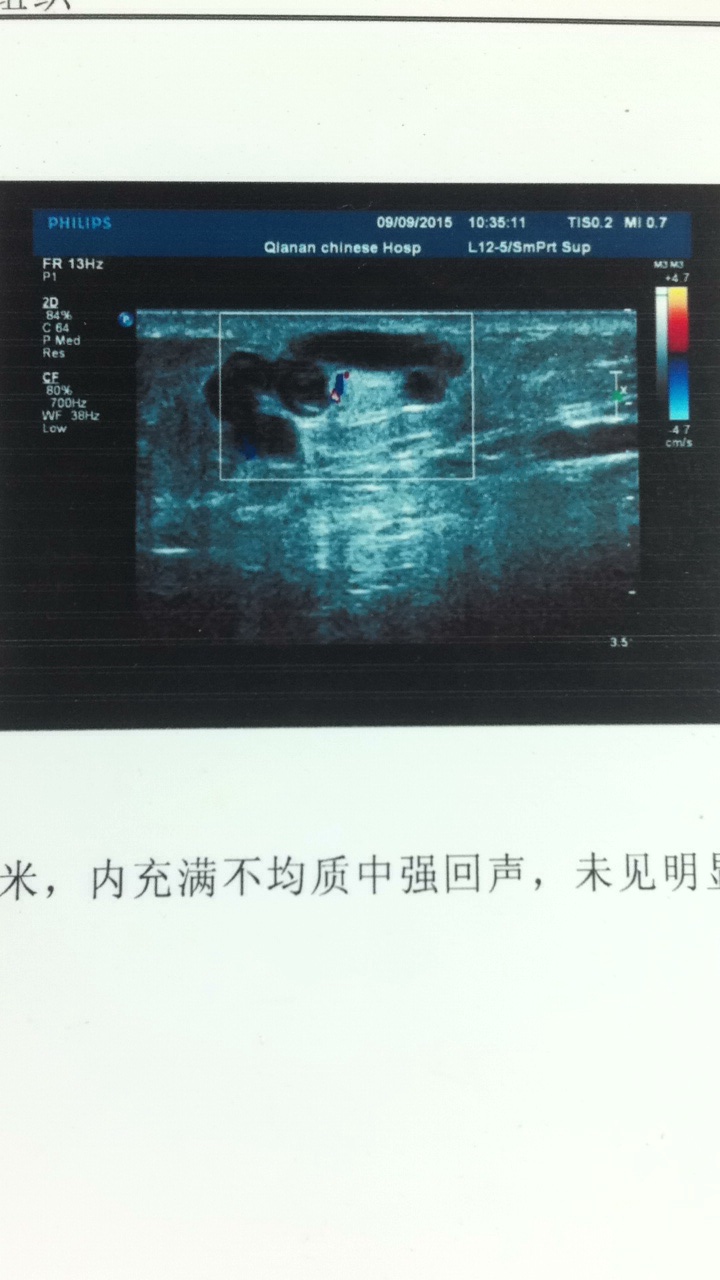 腓静脉超声图像图片