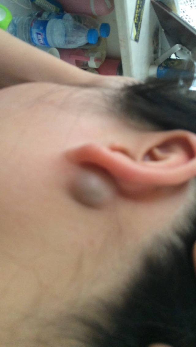 耳后乳突部位长个包图片