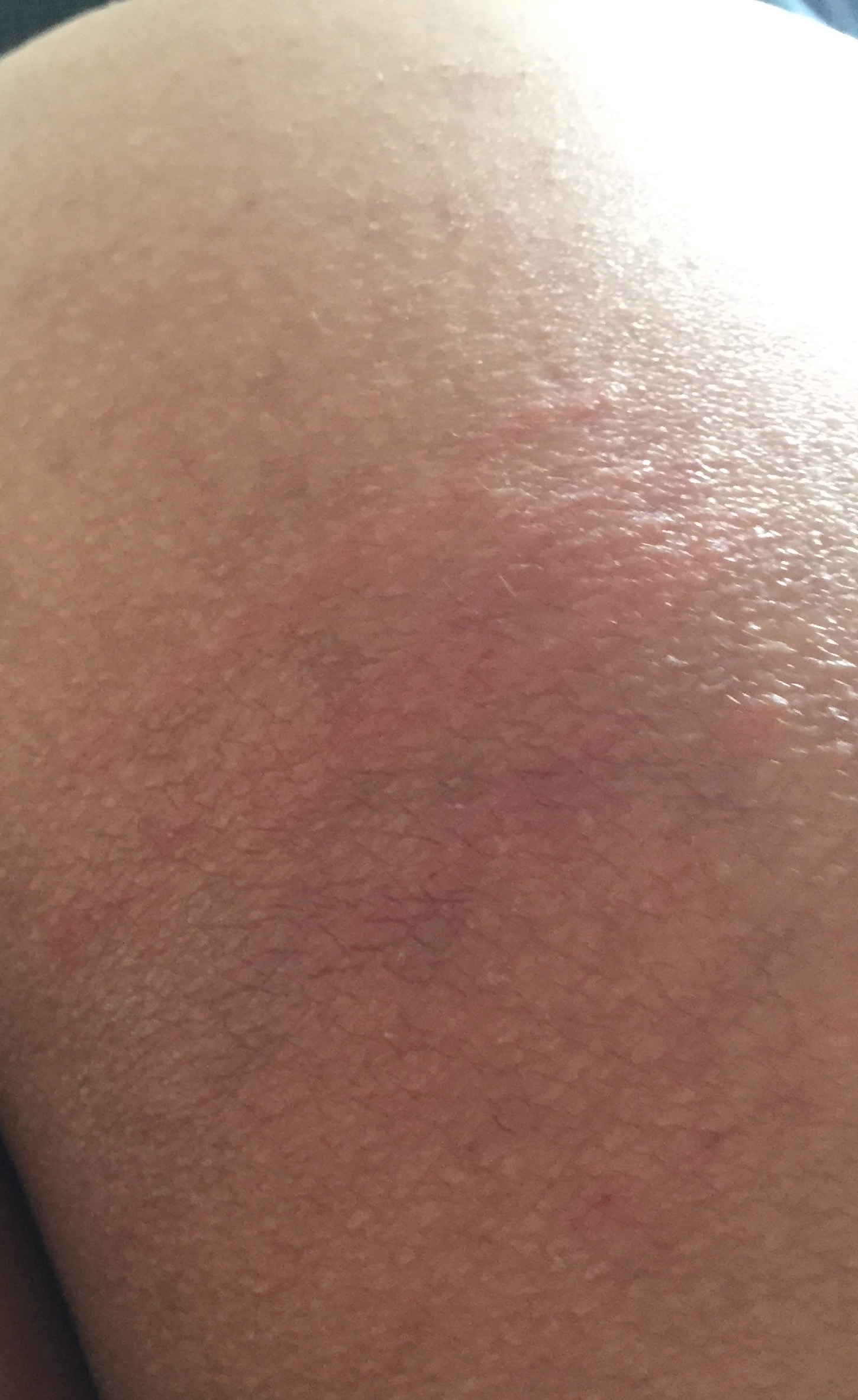 臀部皮肤有几条红斑凸起有瘙痒疼痛感周围皮肤没有疼痛感持续了一