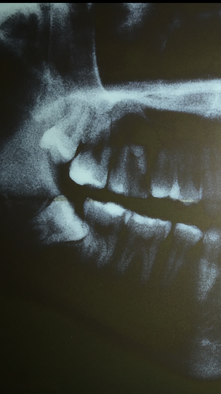 左上角从左往右数第三颗三年内陆续疼过几次疼的时候有牙周袋几天
