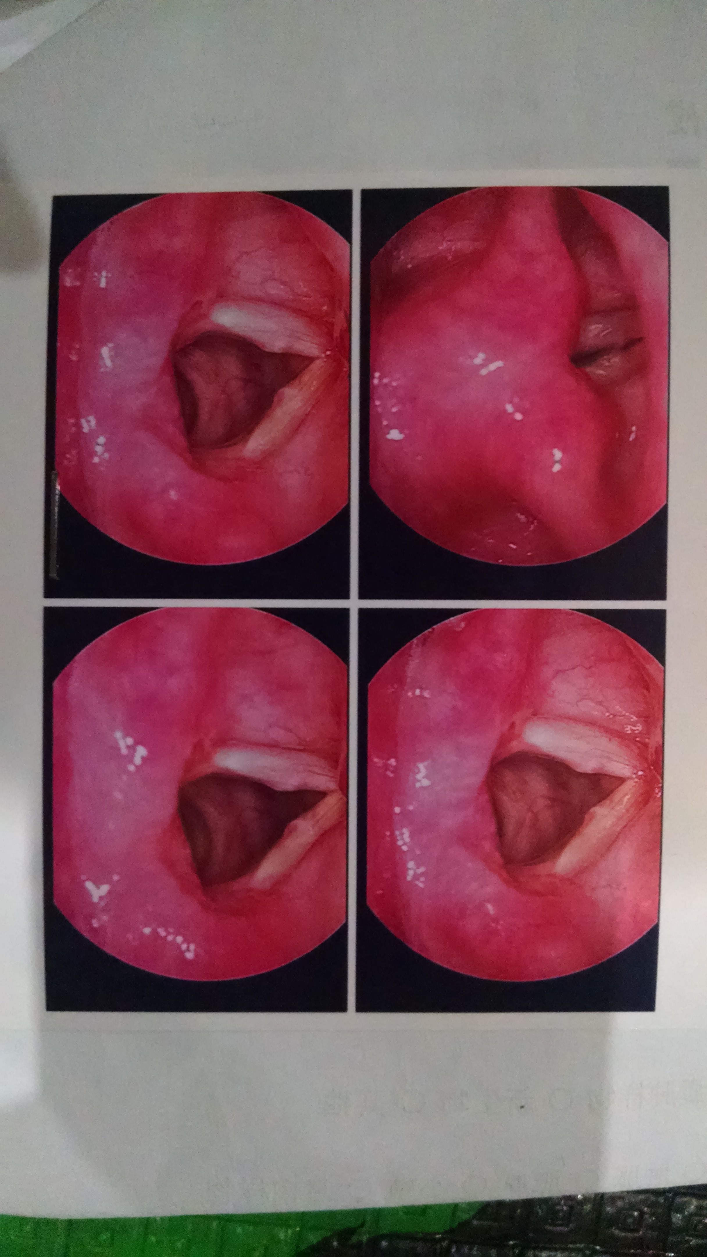 喉咙长息肉图片