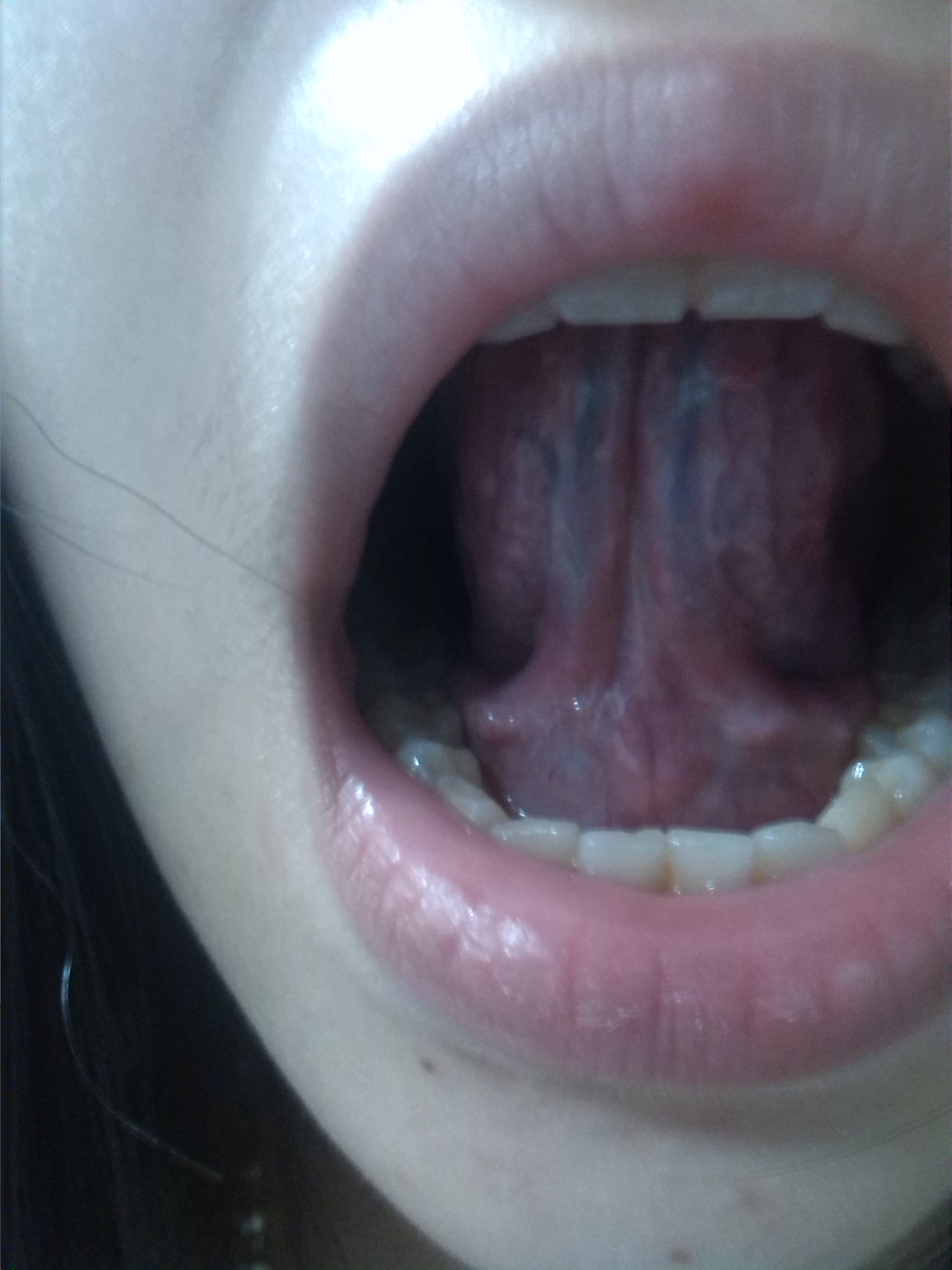 医生我想请问下我的舌头这样是怎么了而且根部摸起来有一点一粒