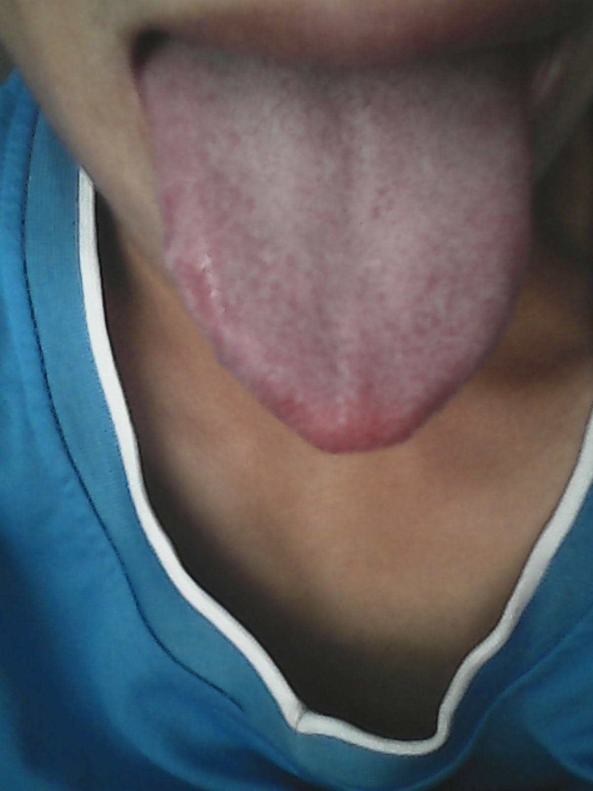 肺火大的舌苔图片图片