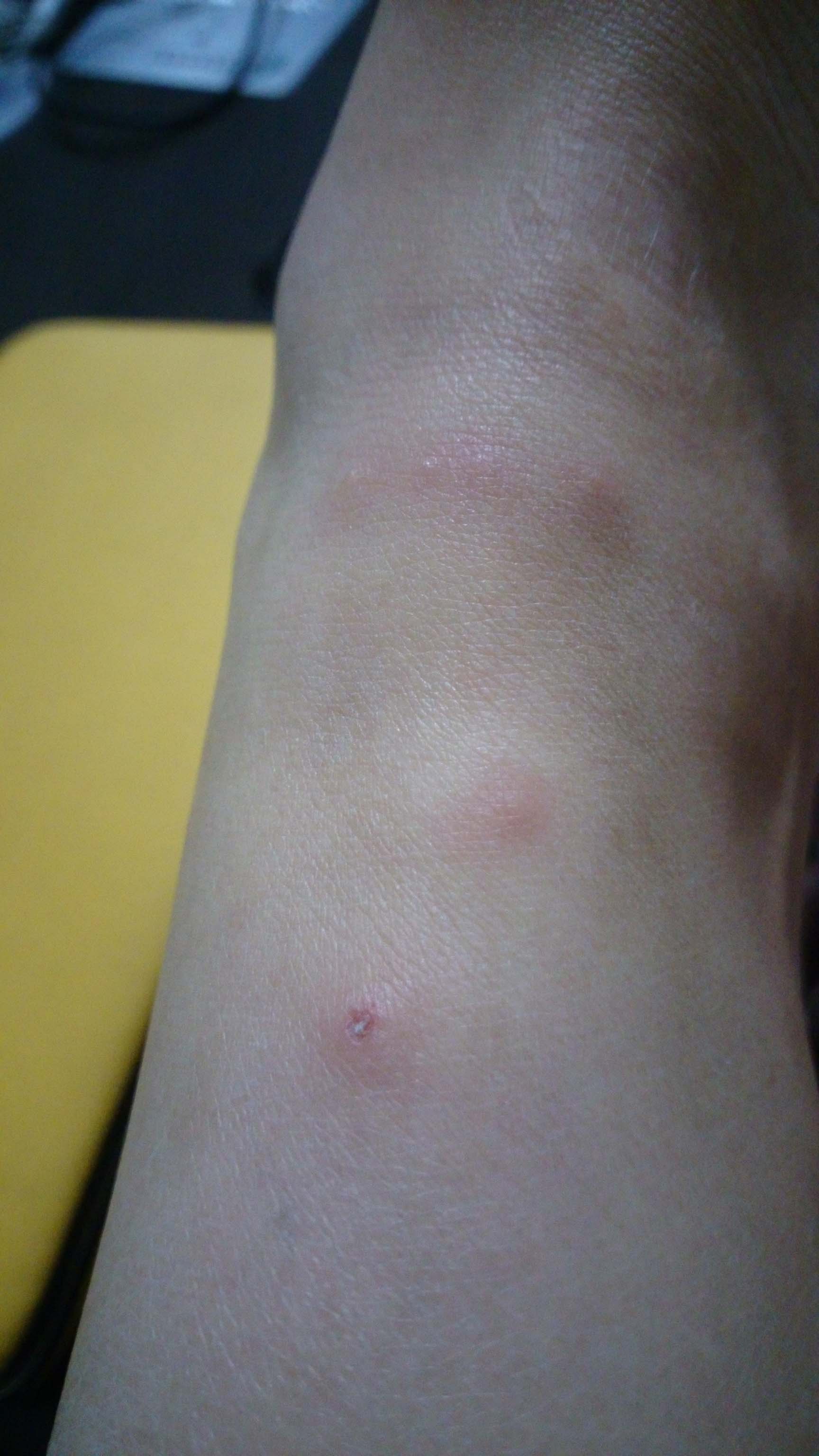外出旅行回来后脚踝长了许多类似蚊子咬的包一样的肿块顶端有