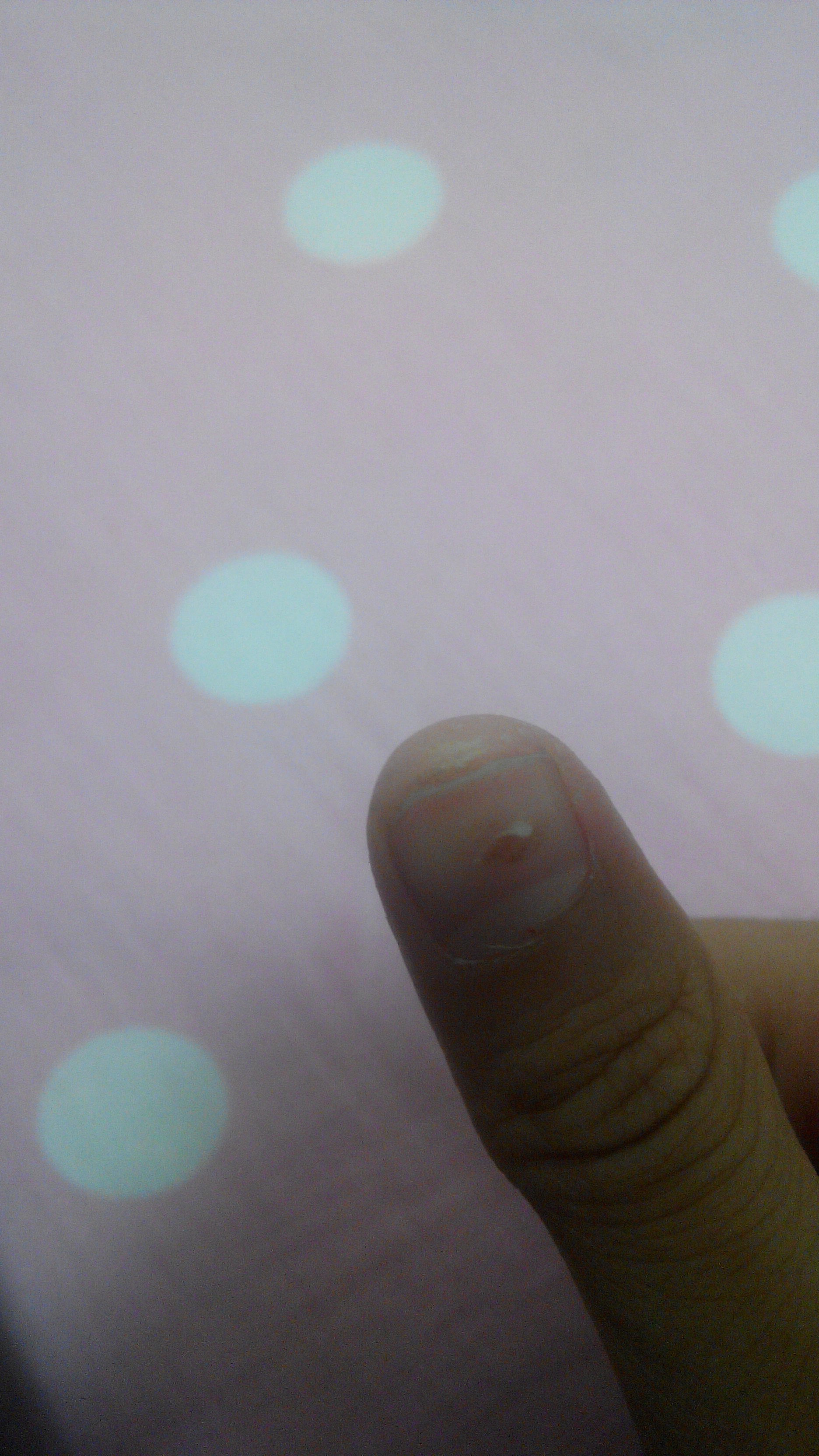右手大拇指指甲缝很疼疼了要三天左右指甲上的红点得有聊个月