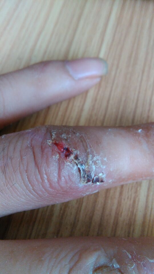 那个我手指筋断了,已经吻合20多天了,前几天我拆了线,外部的