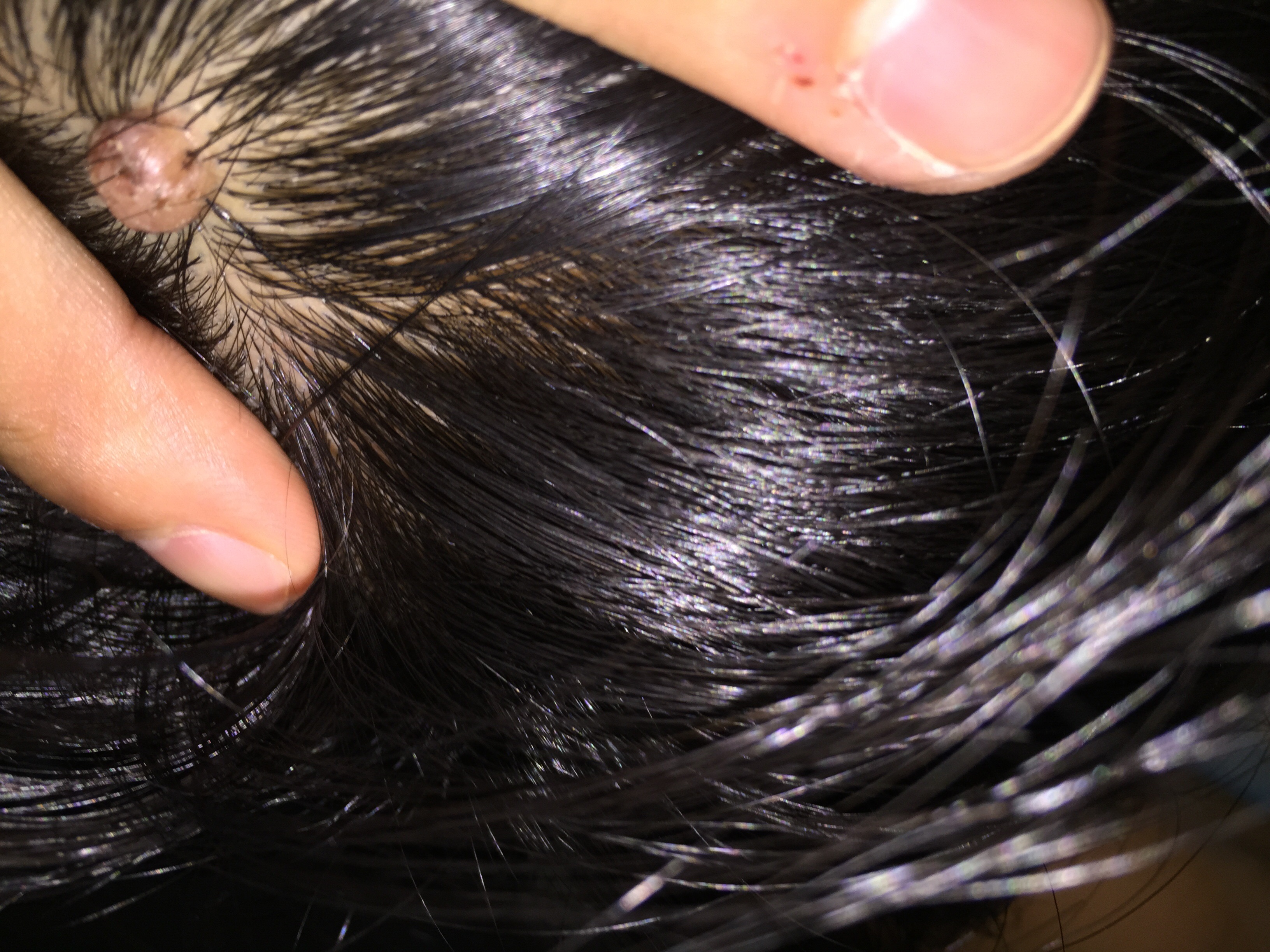 头发里从小时候到现在的一颗肉痣不知道有没有癌变的可能需要怎么