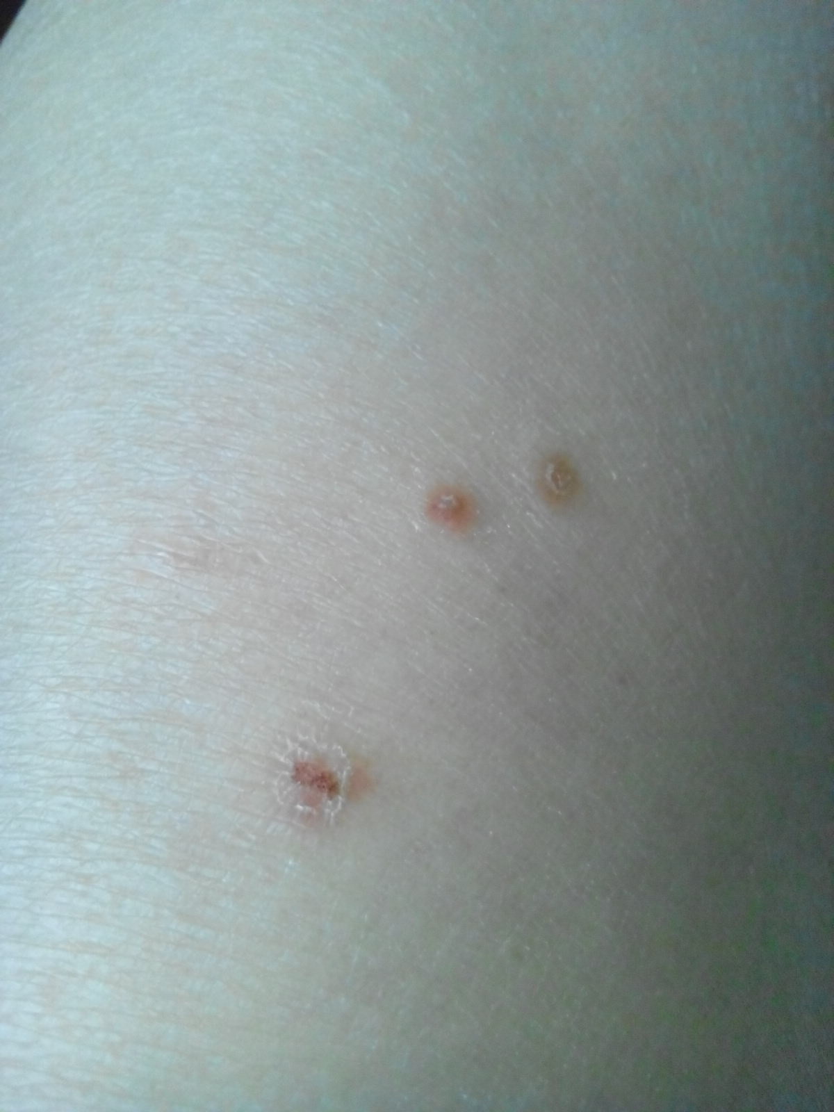 今年春天开始胳膊上有两个小疙瘩,有点黑,有点痒,没管他总觉得