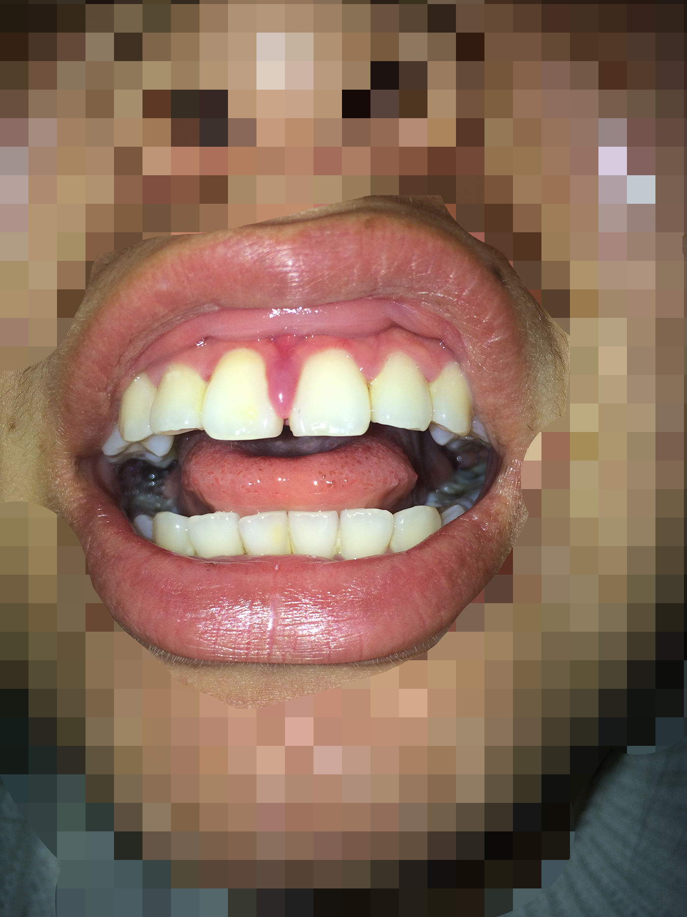 门牙牙龈肉凸起来了图片