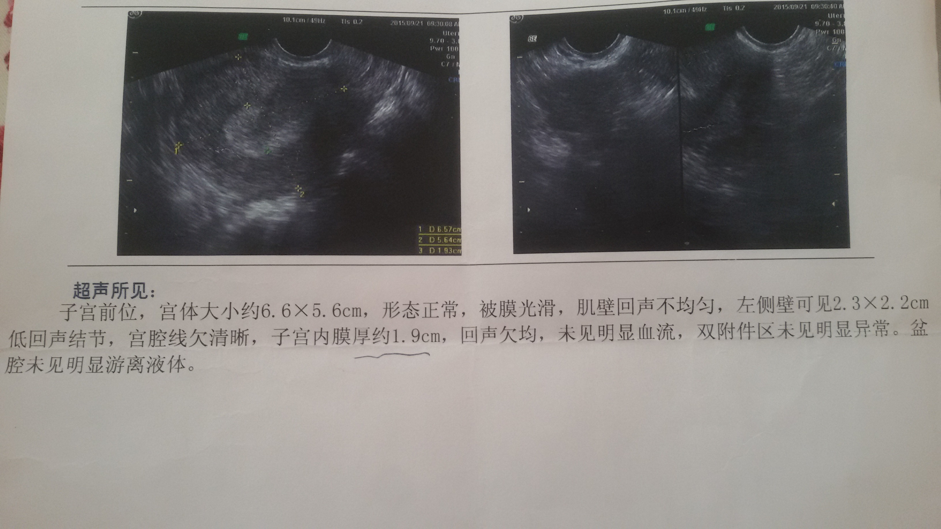 我来月经前三天左右检查子宫内膜厚度是19cm这个厚度正常
