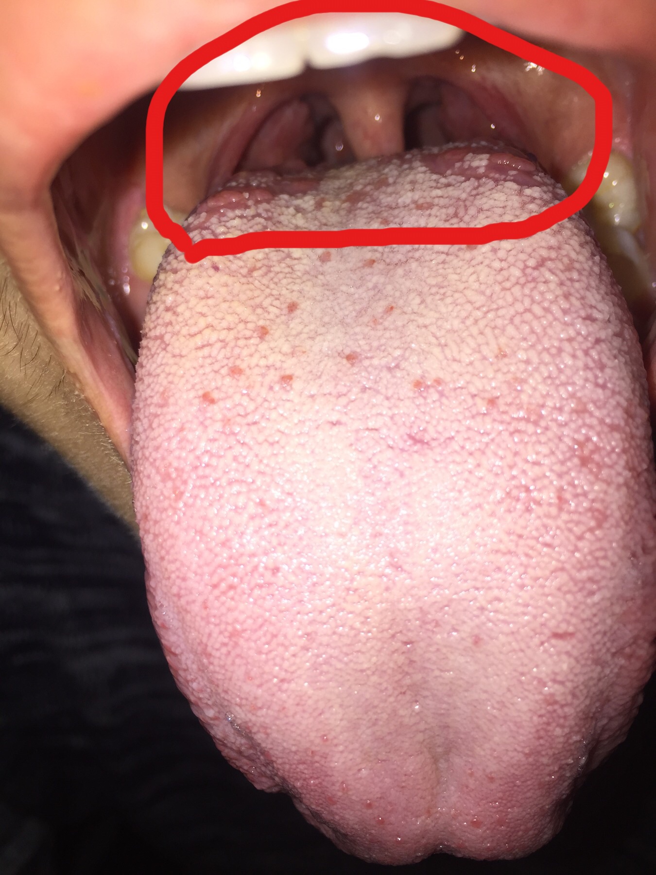 舌根有一块肉会翘起来图片
