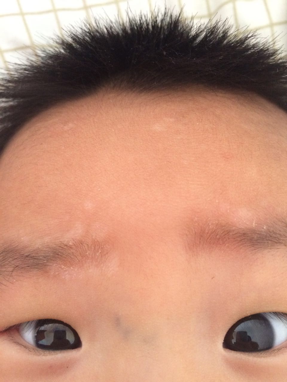 孩子(男,4个半月)眉毛上长了白色的东西,不知道是什么,也不