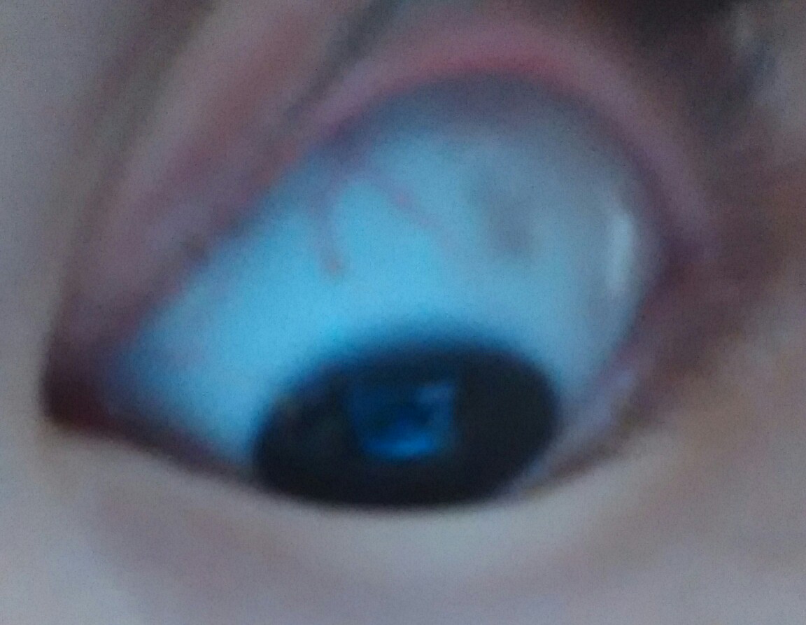 眼白上有青灰色的斑点似得东西前些天在医院检查眼睛因为白红
