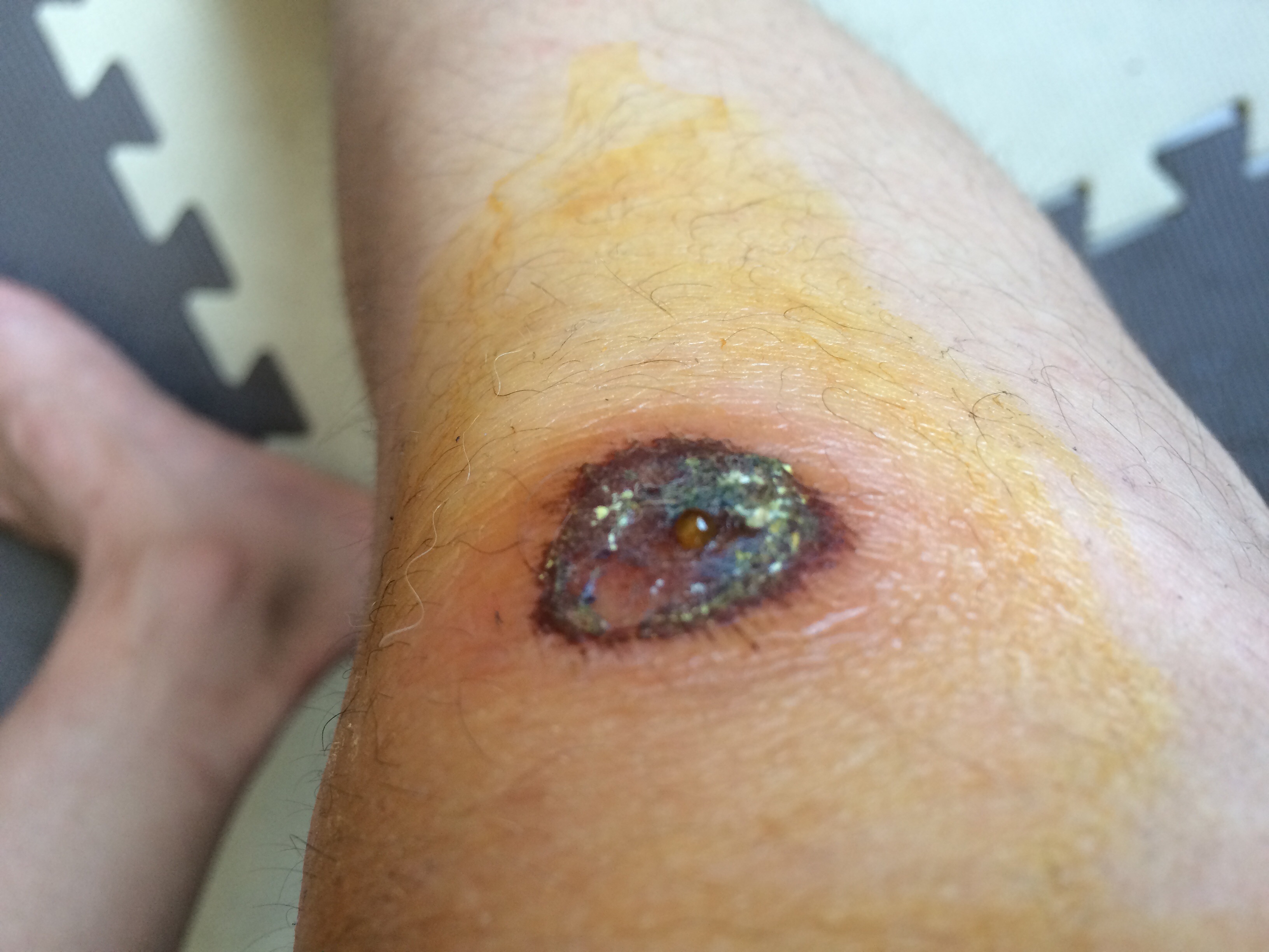 伤口感染化脓症状图片图片