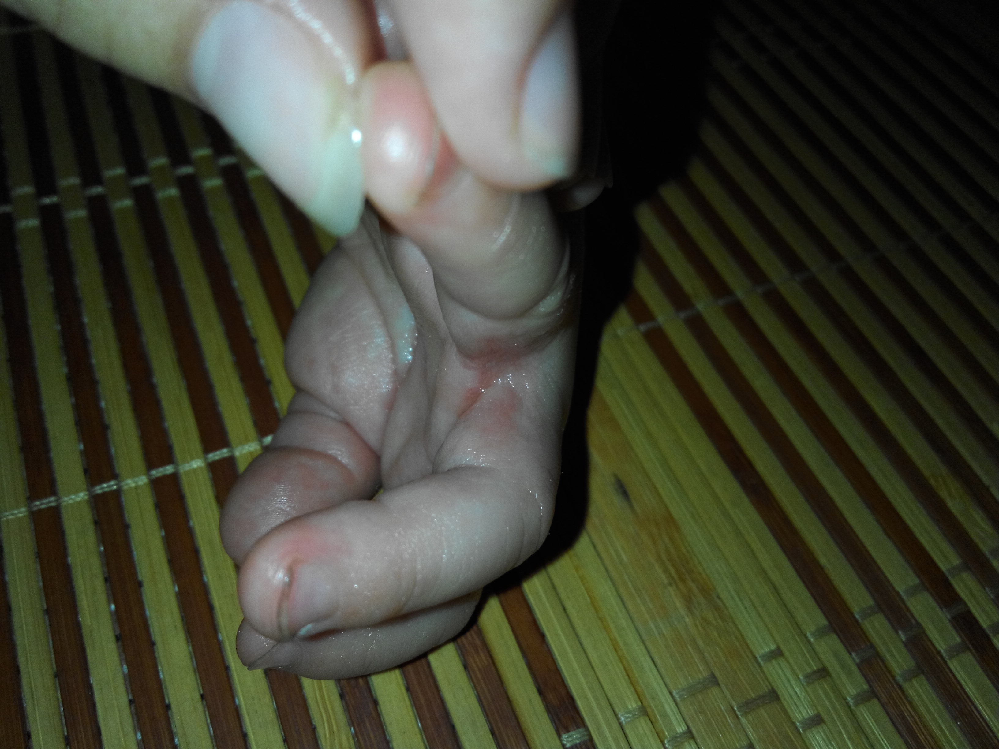 差不多一个星期前发现小孩手指缝里红红的好像要烂了一样