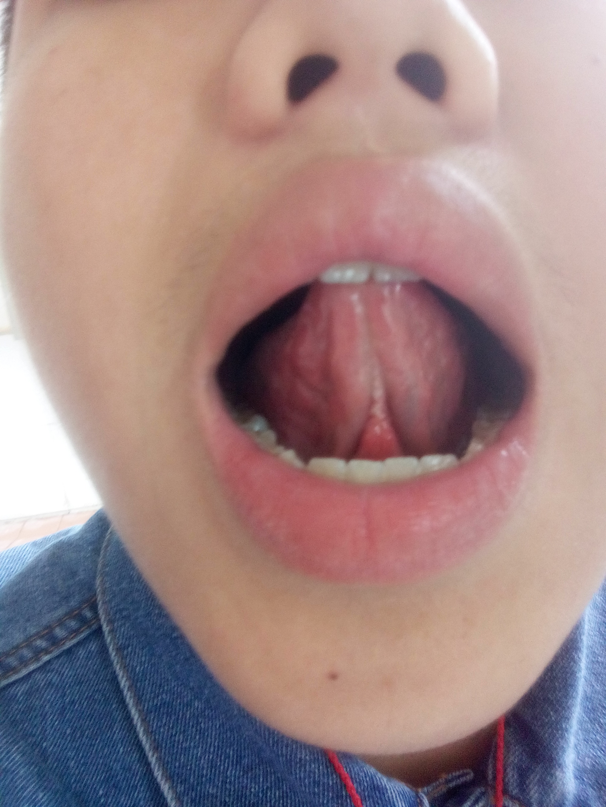 舌下腺发炎的图片图片