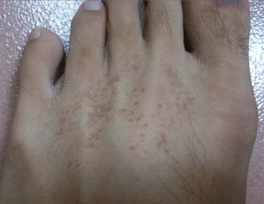 我的脚掌这阵子长着黑斑,一片一片的,不痛不痒,已经有两个多月