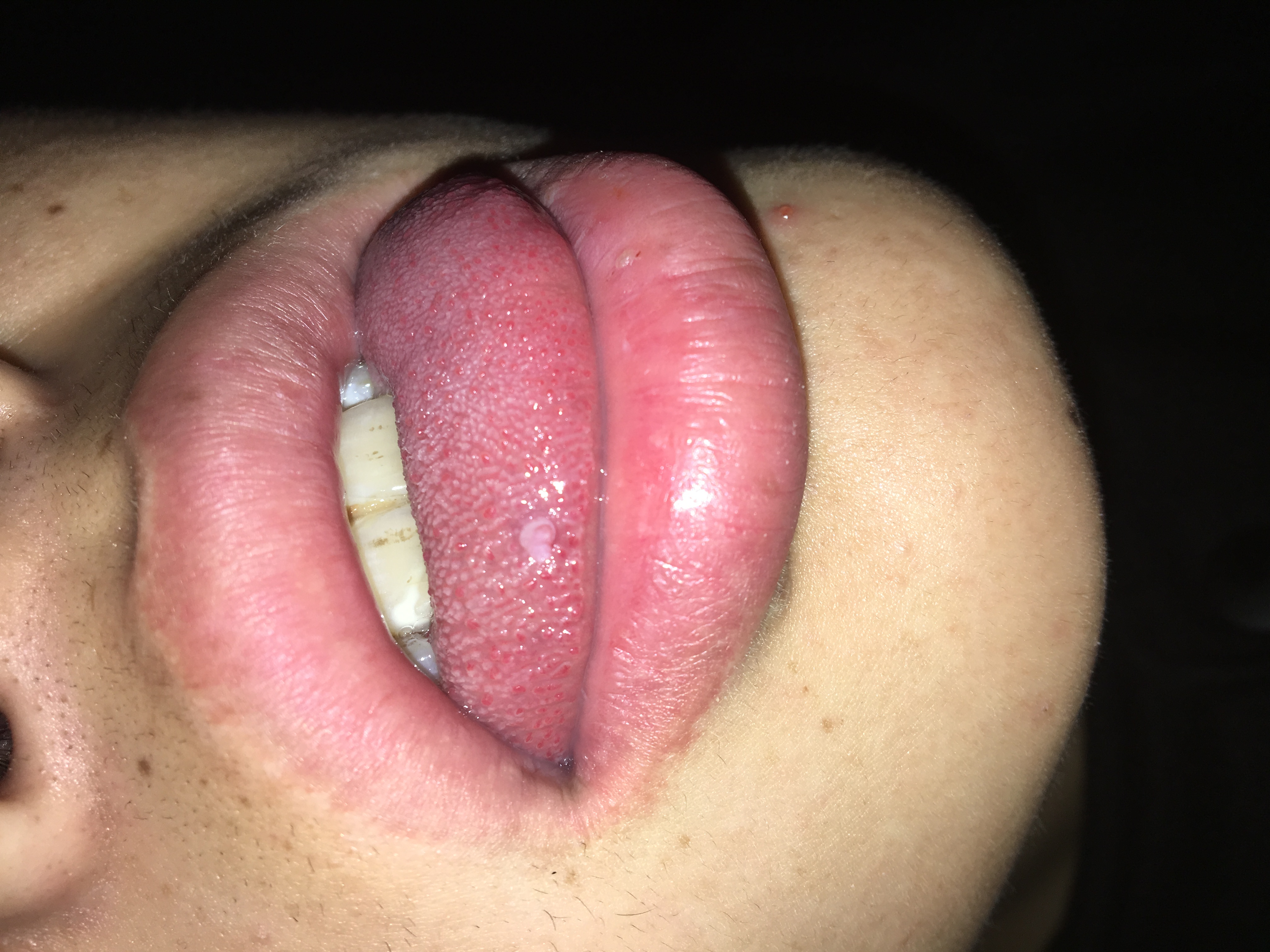 舌纤维瘤图片图片