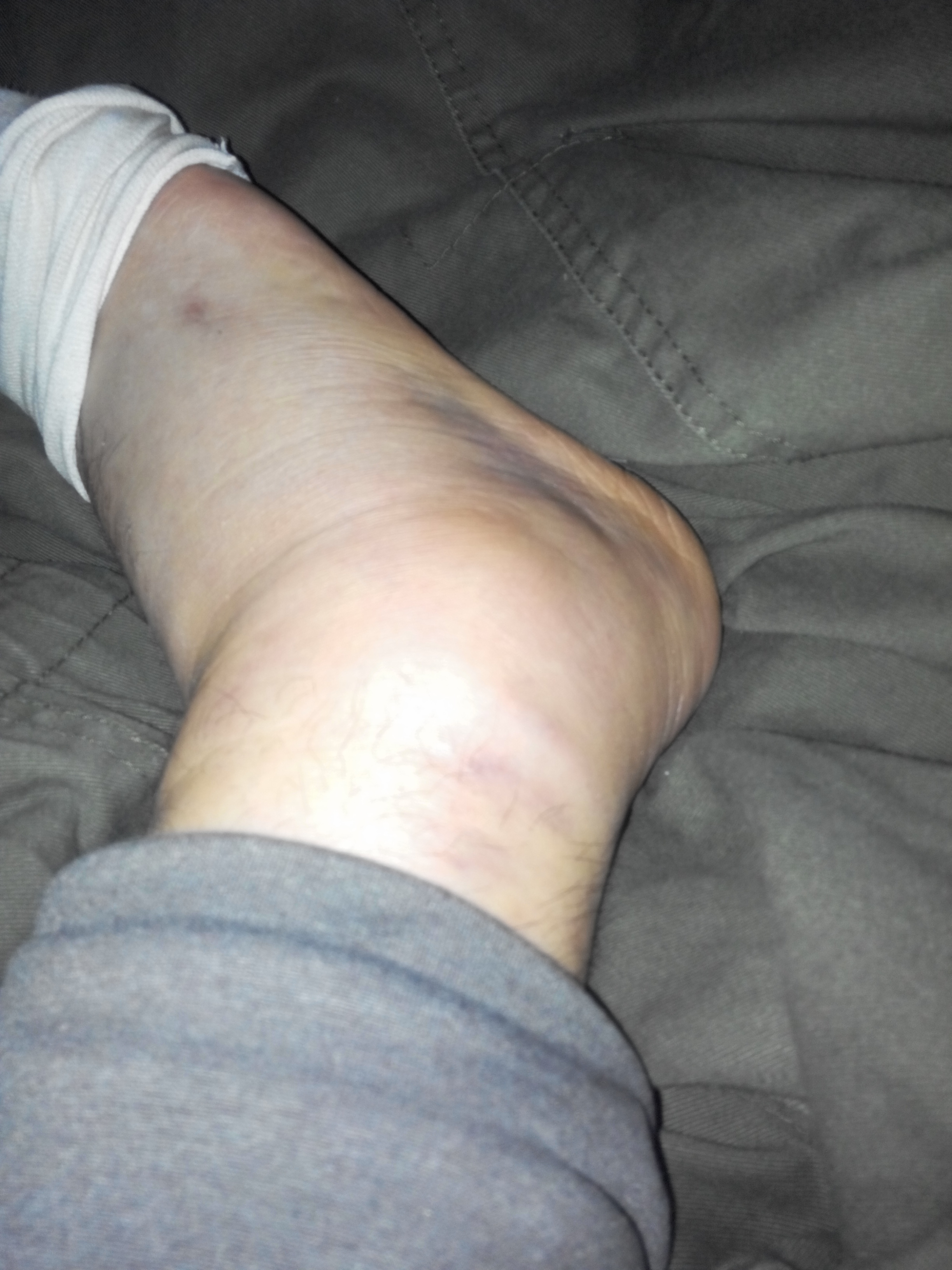 脚踝韧带拉伤症状图片图片