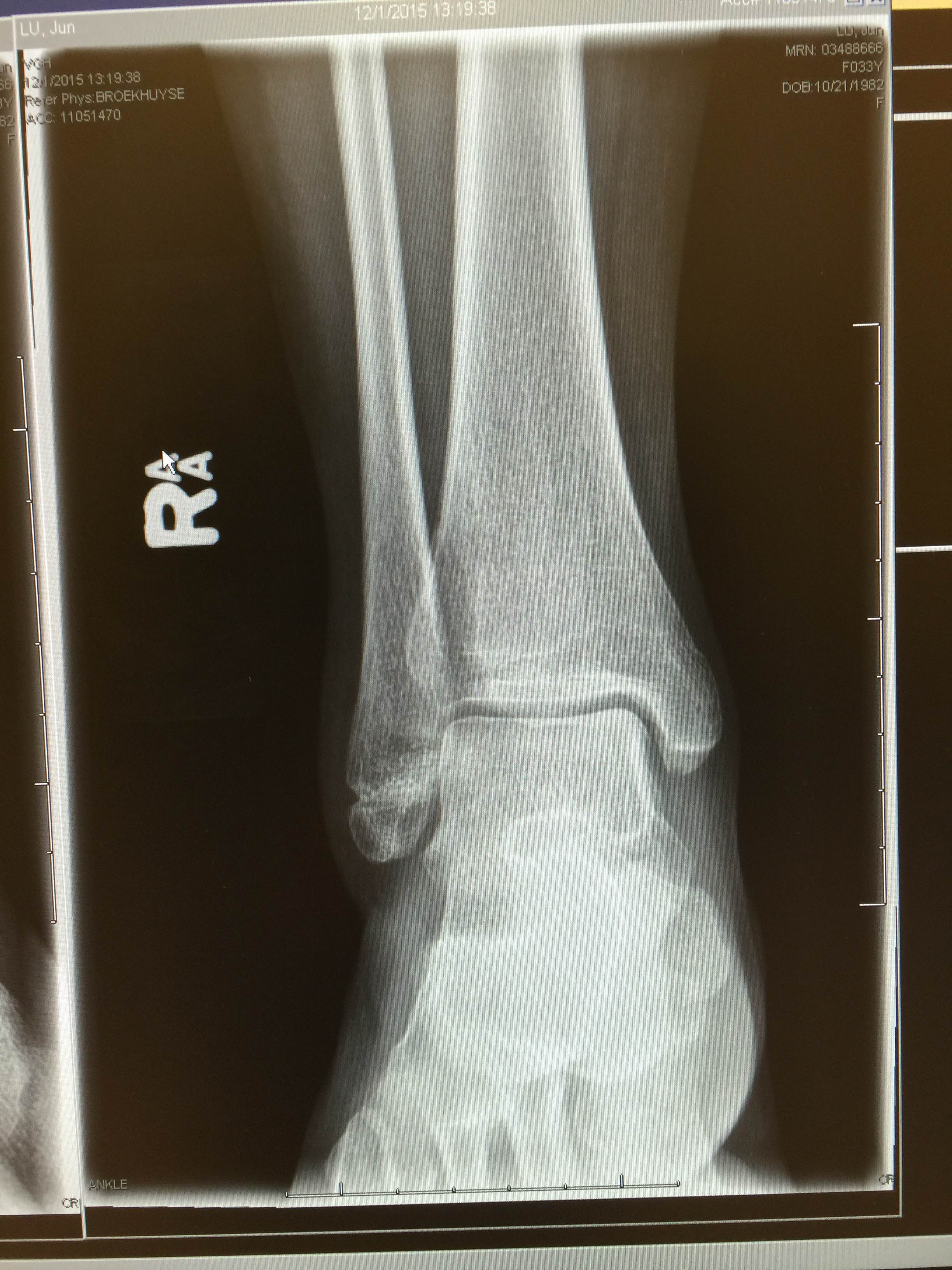 右脚骨裂x光片图片图片