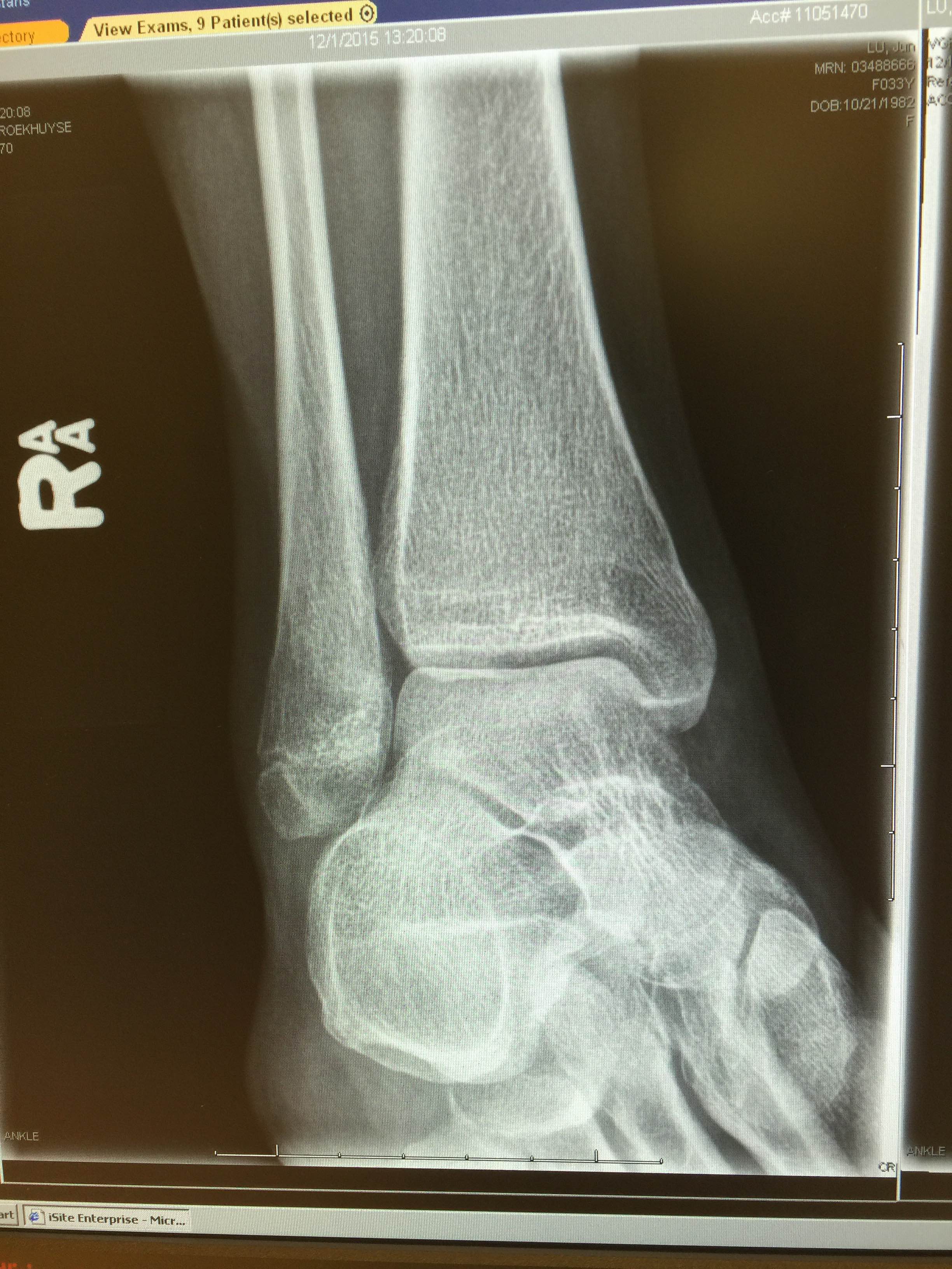 右脚脚踝骨折x光图片图片