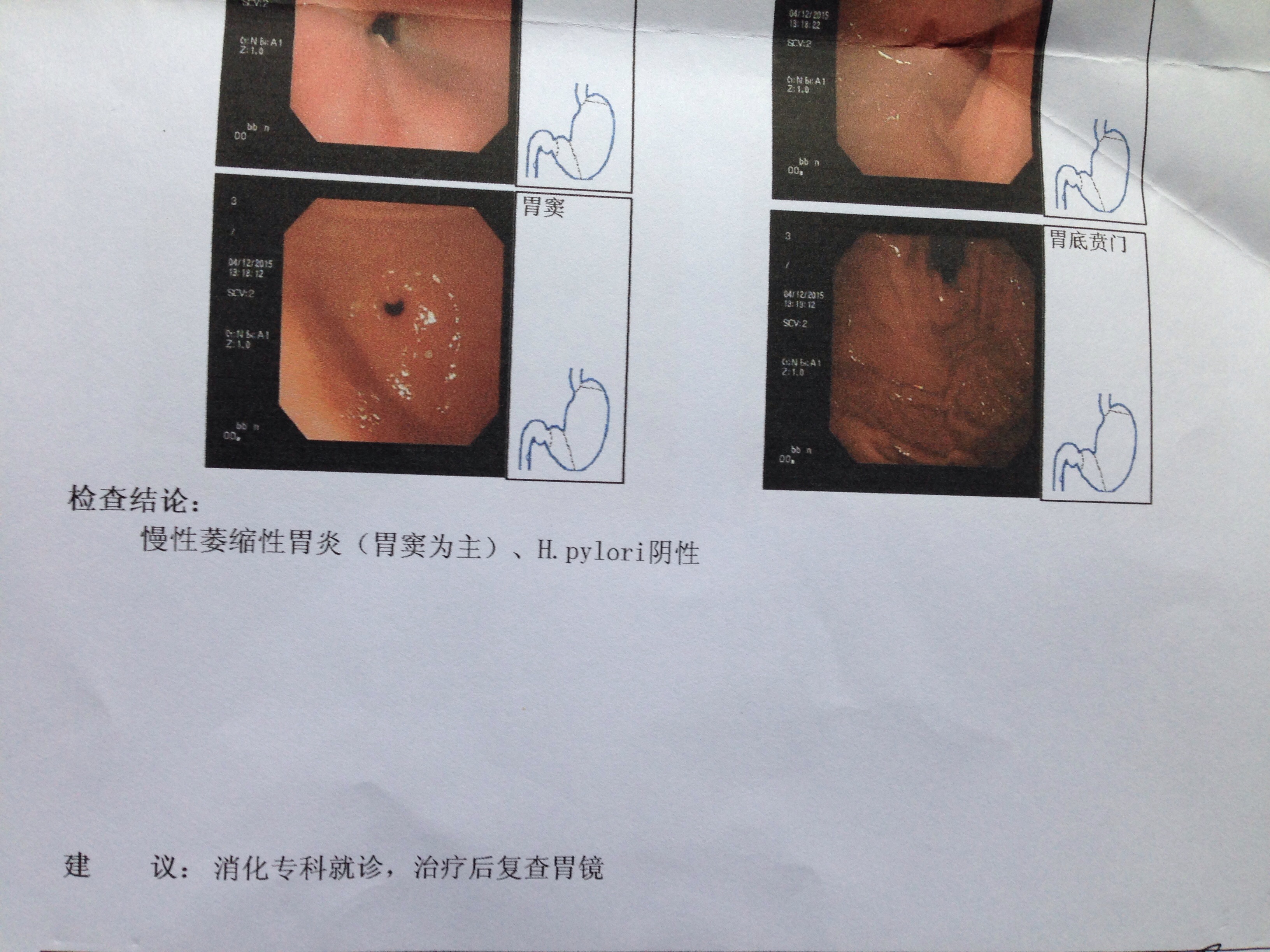 胃癌中期胃镜单子图片图片