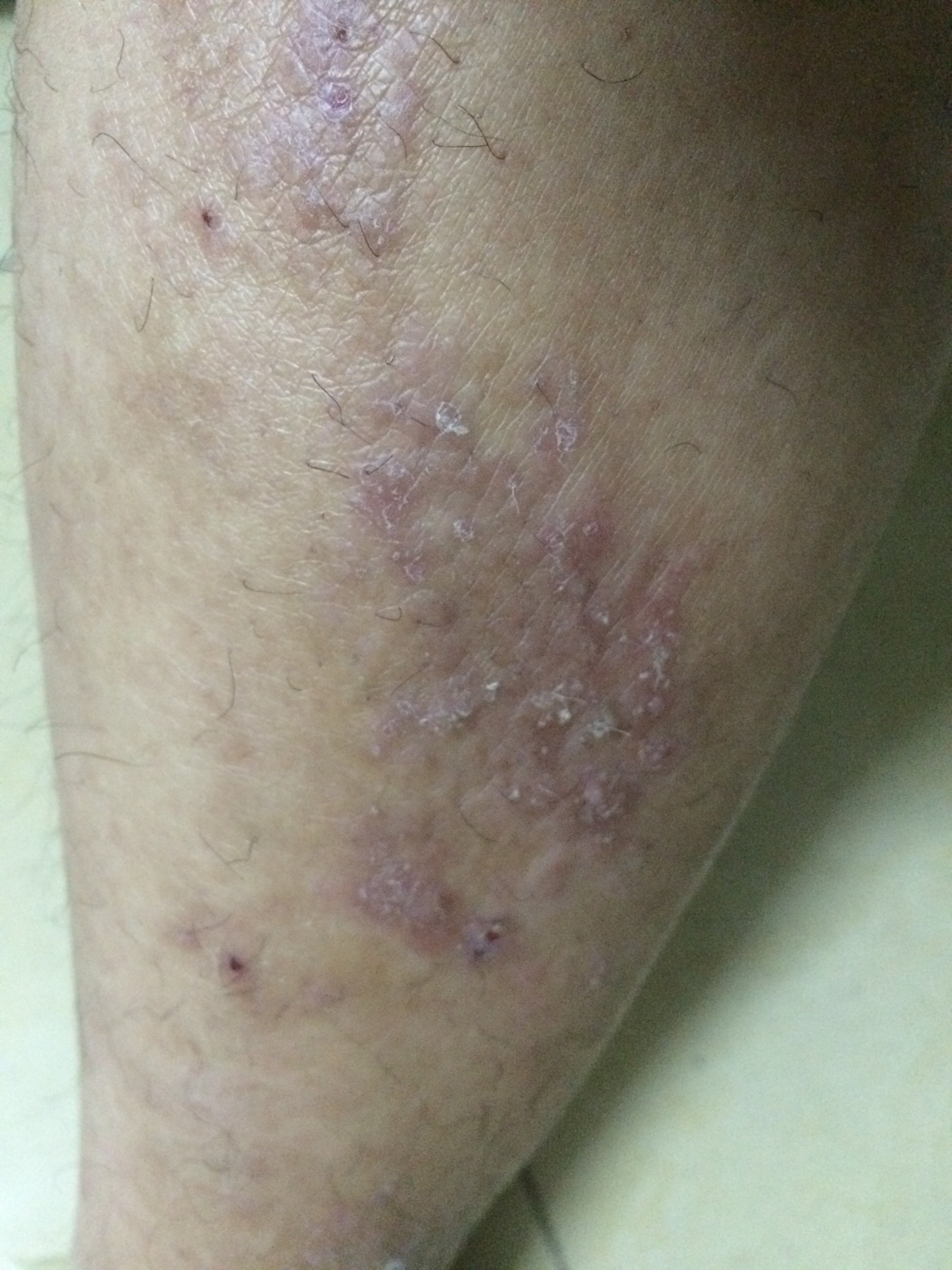 小腿皮肤瘙痒症图片图片
