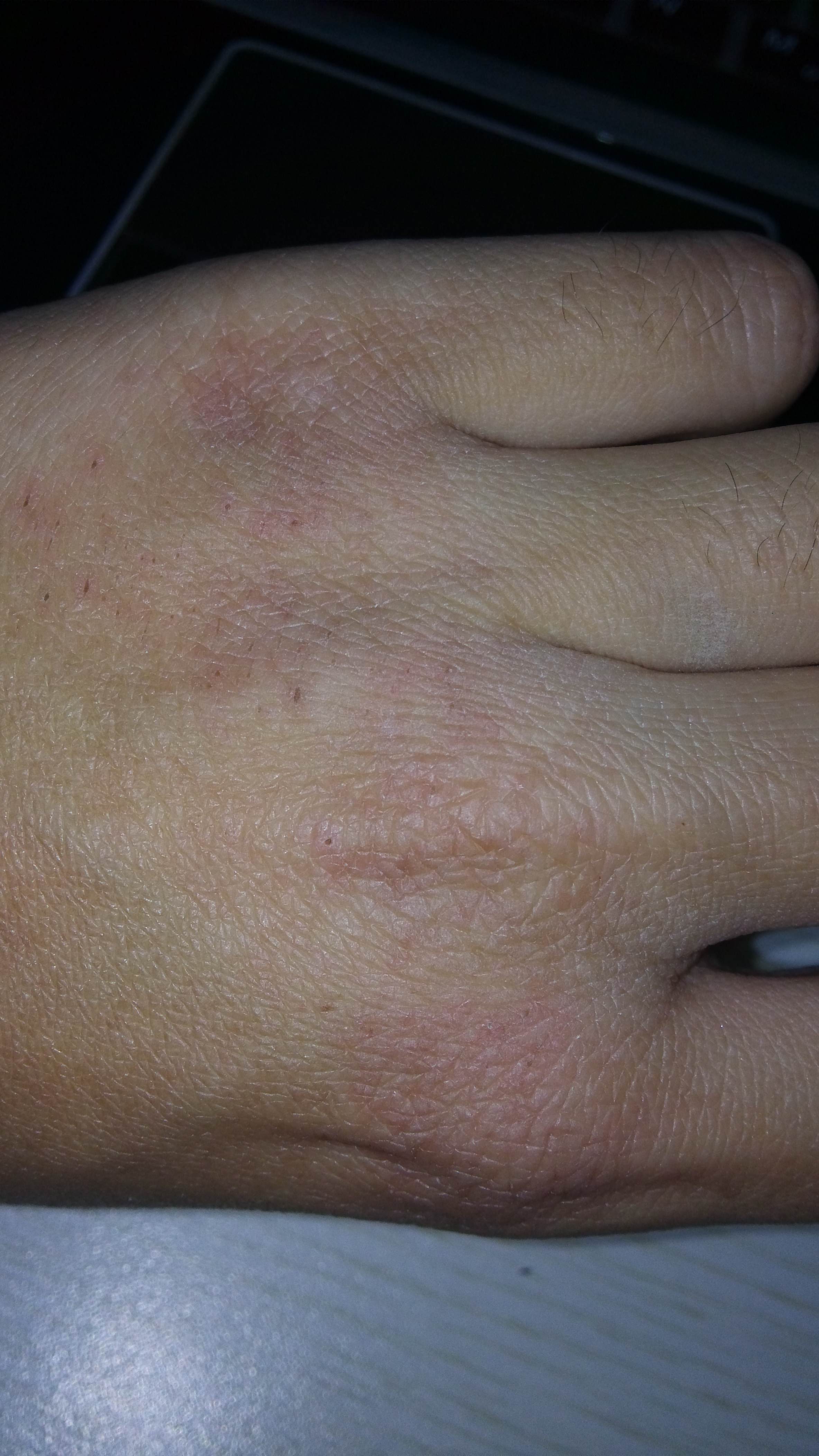 请医生看下我手背的干裂和红点这是被冻的还是一种皮疹为什么