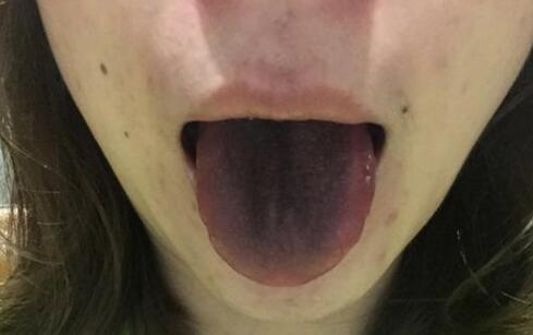 舌苔发黑图片怎么回事图片