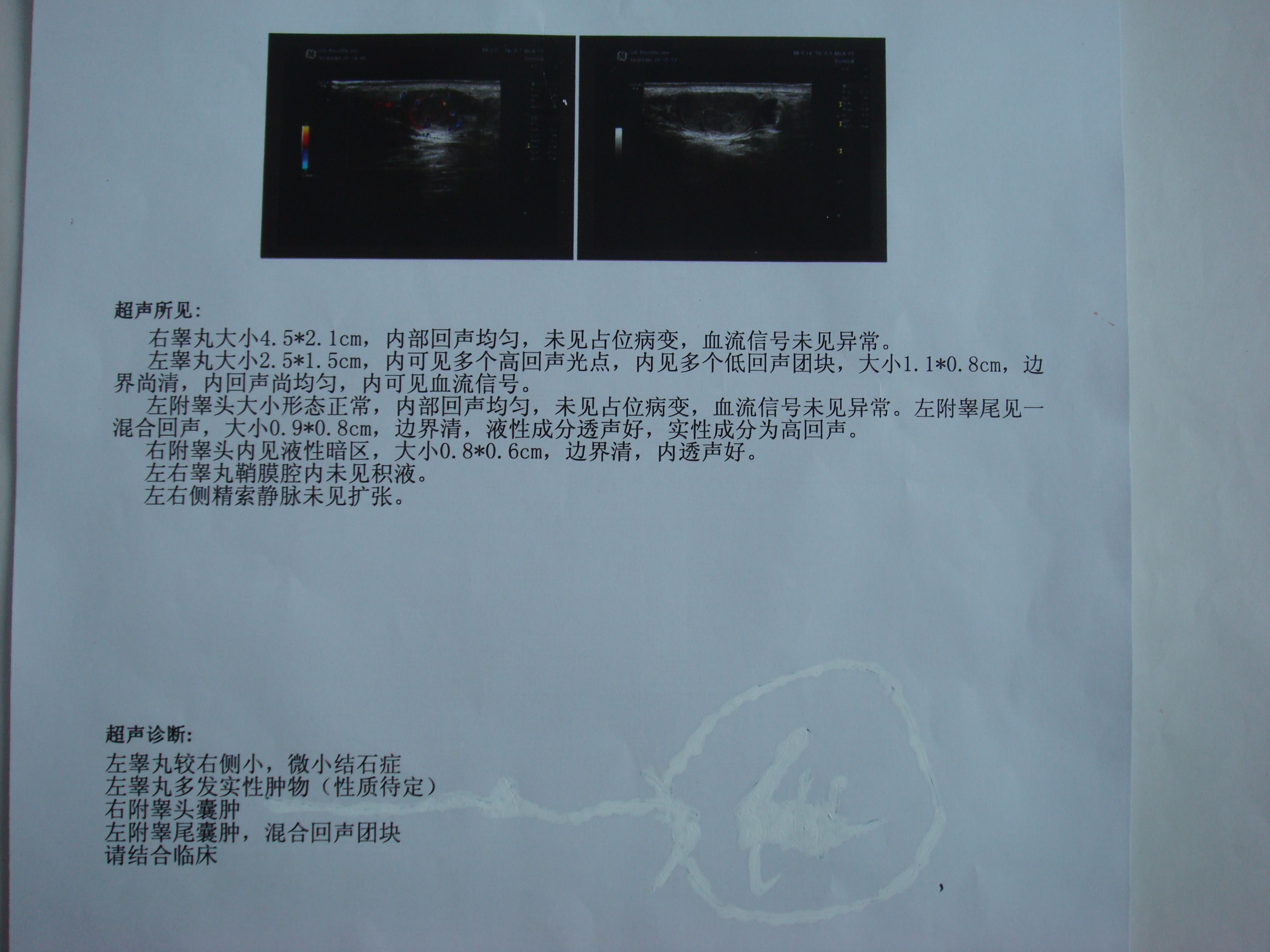 因小時候做過隱睪手術距離現在27年了左側睪丸一直偏小