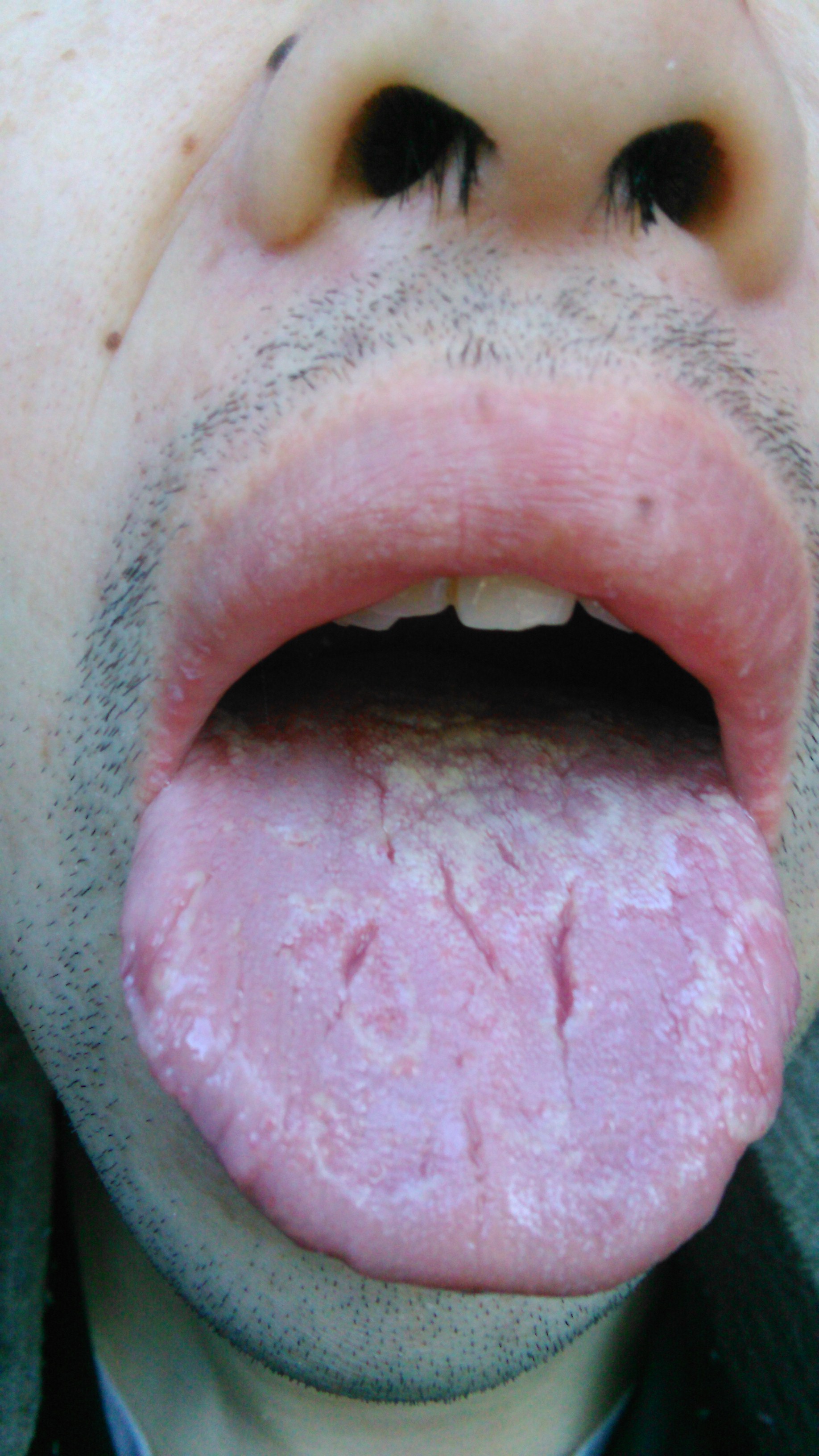 舌苔青紫色的图片图片