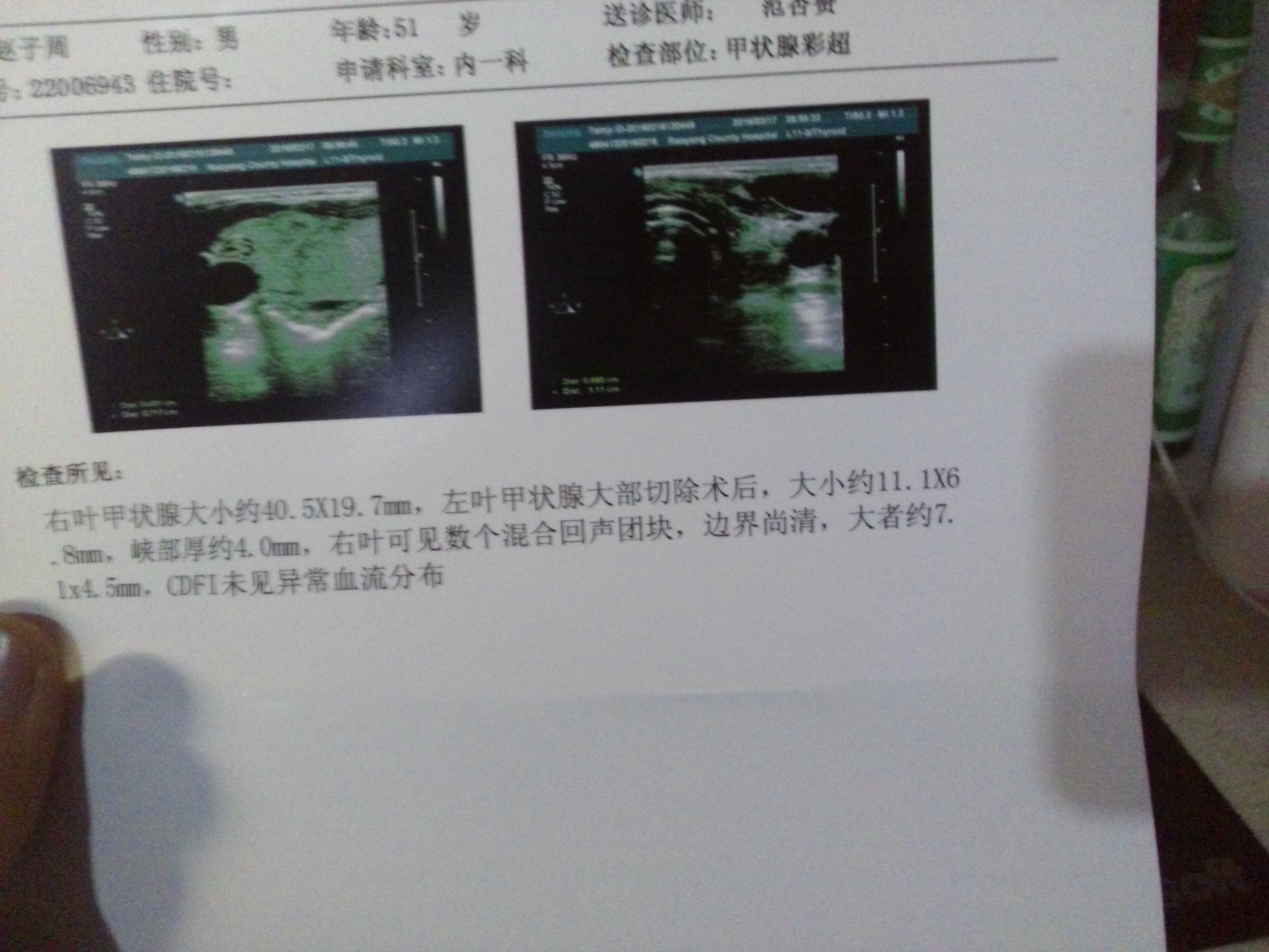 甲狀腺右葉可見數個混合回聲團塊邊界尚清大者約71mm