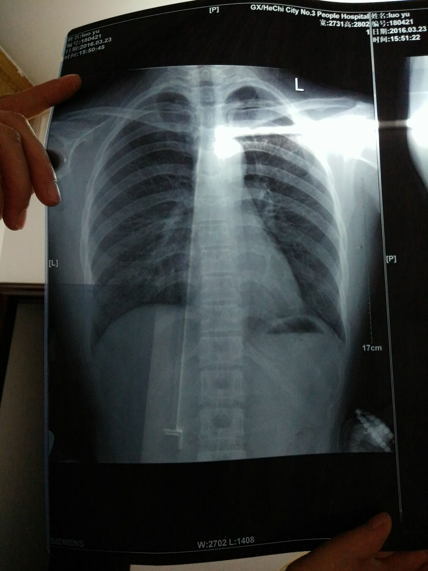 颈肋的x线图片图片