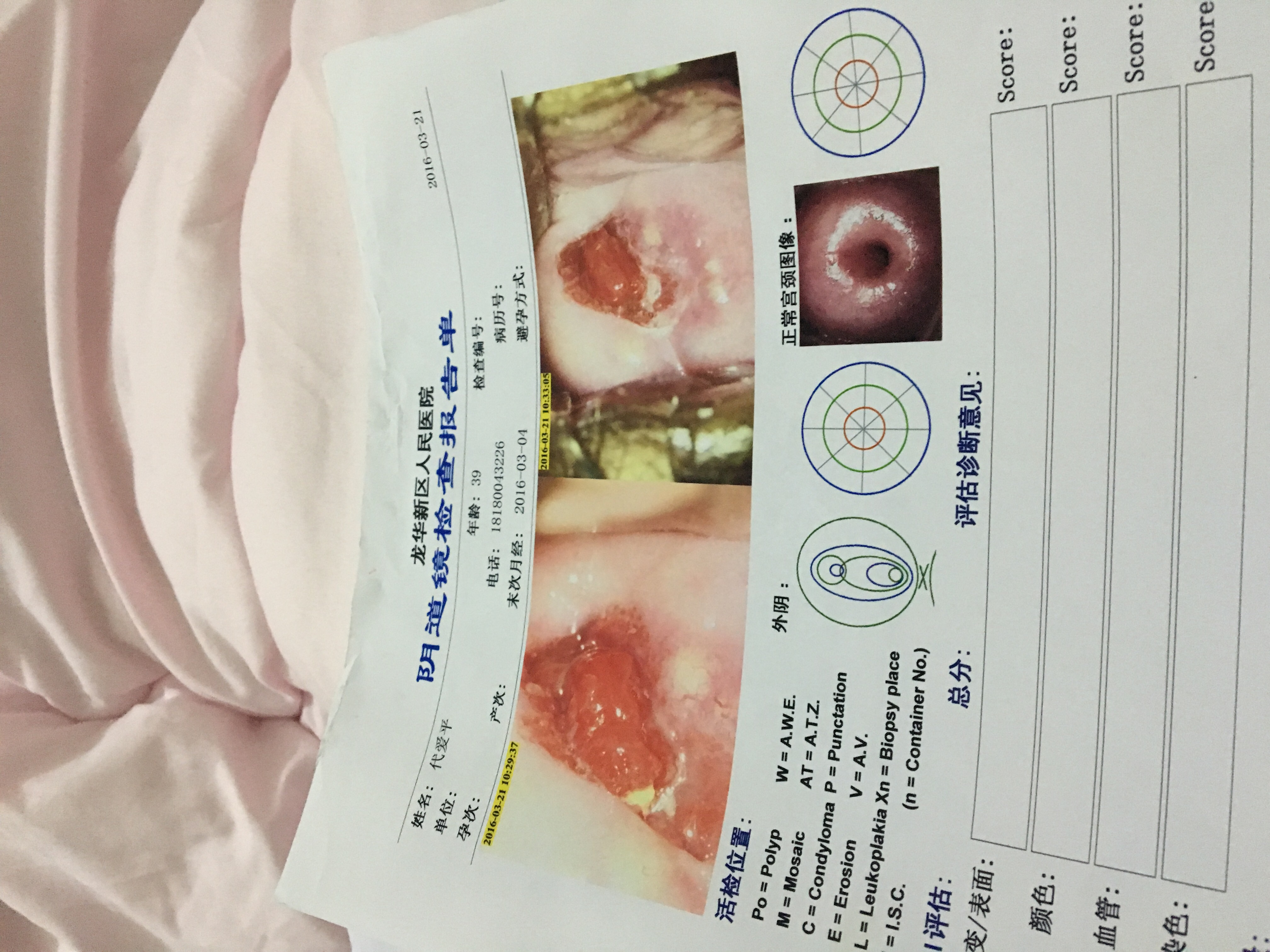 宫颈息肉图片治疗方法图片